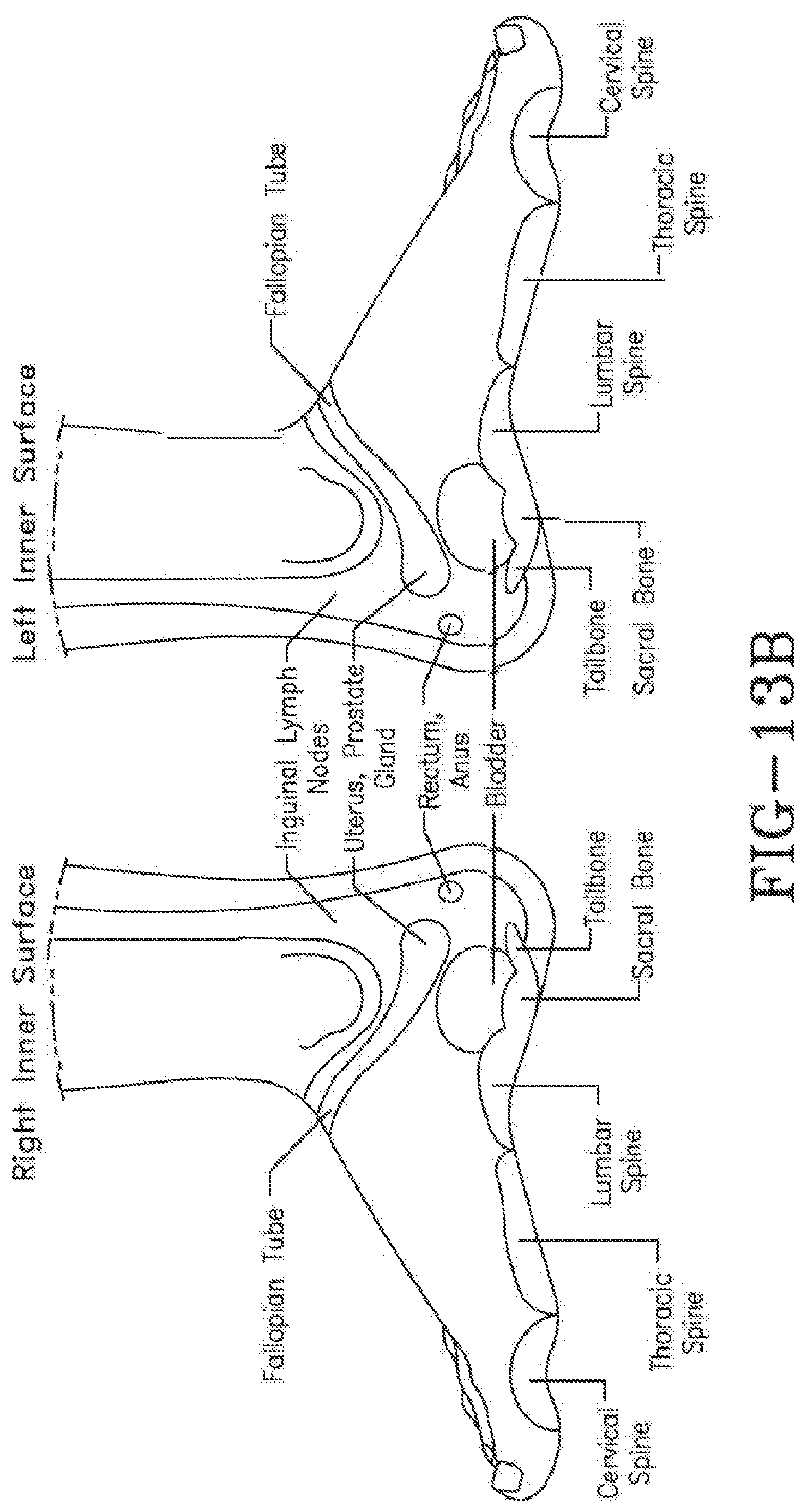 Patent US11771620 Figure 11 – Acoustic shock wave therapeutic methods to prevent or treat opioid addiction