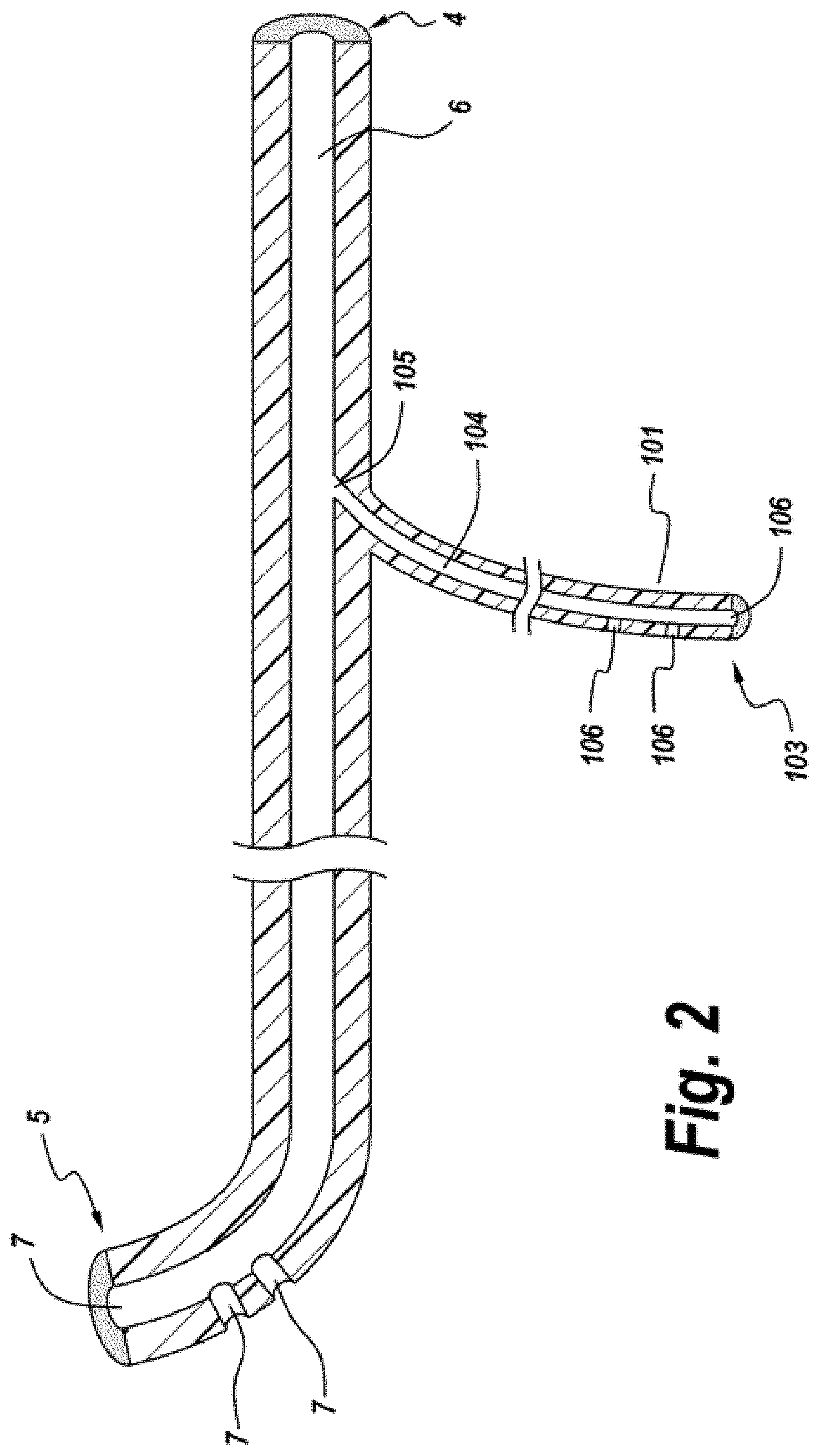 Patent US11771626 Figure 3 – Diverting jejunostomy tube