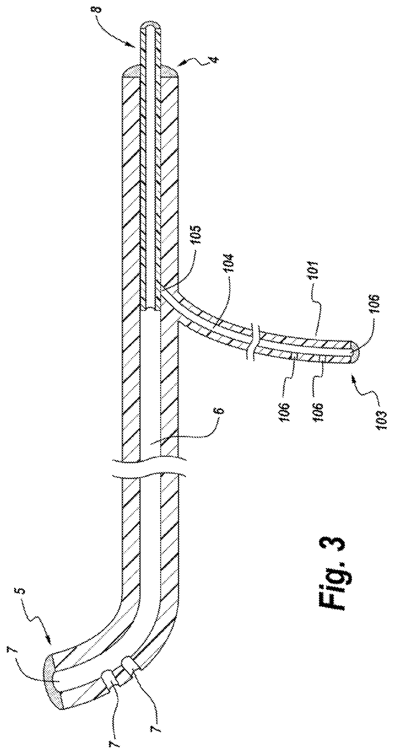Patent US11771626 Figure 4 – Diverting jejunostomy tube