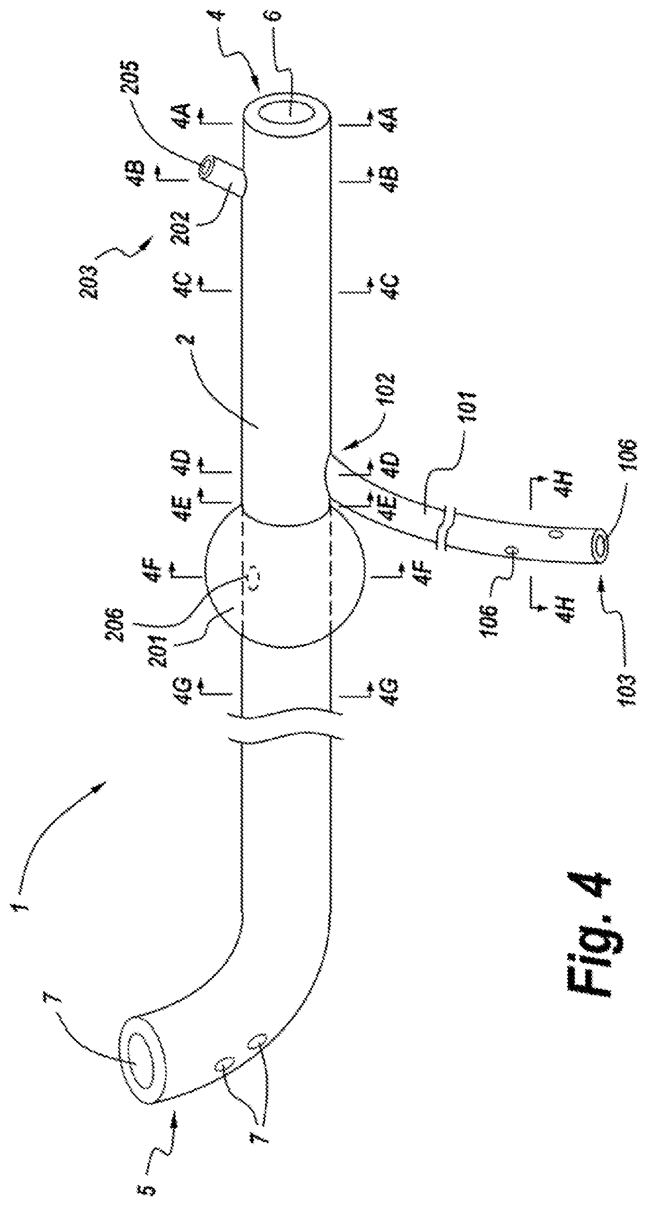 Patent US11771626 Figure 5 – Diverting jejunostomy tube