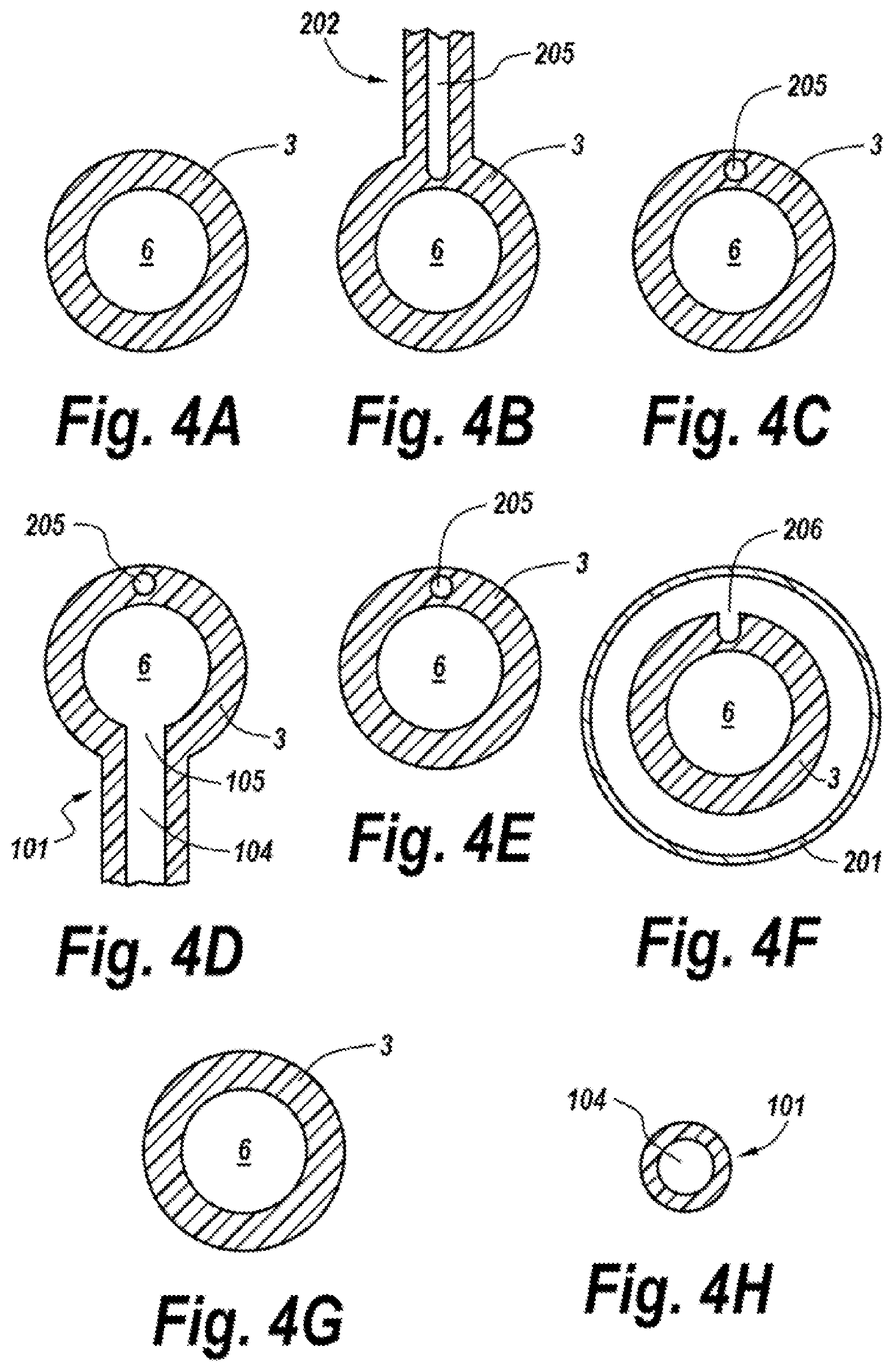 Patent US11771626 Figure 6 – Diverting jejunostomy tube