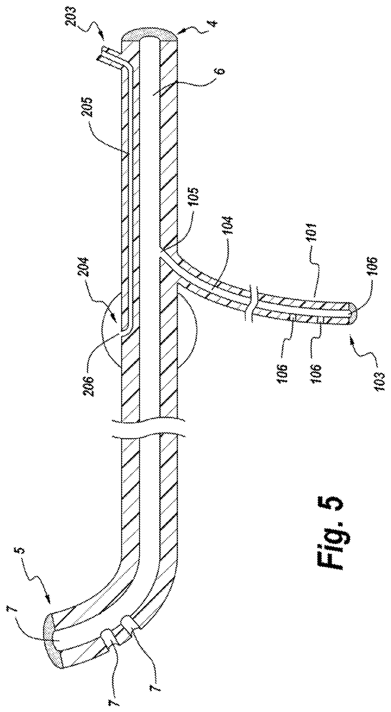 Patent US11771626 Figure 7 – Diverting jejunostomy tube