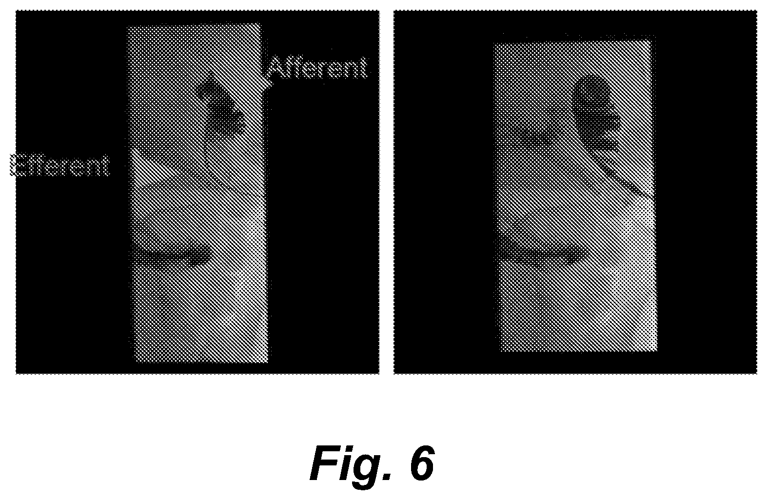 Patent US11771626 Figure 8 – Diverting jejunostomy tube