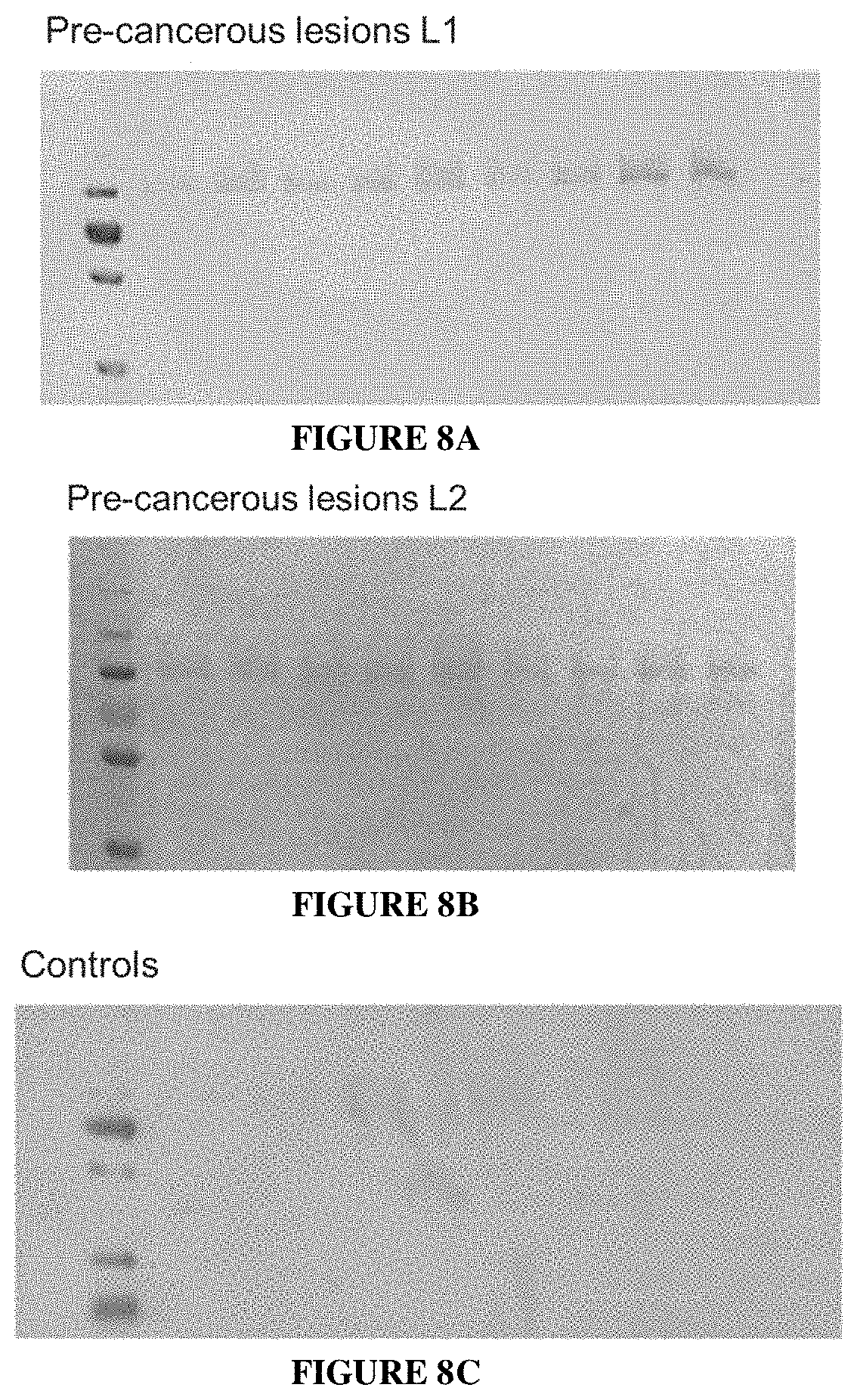 Patent US11771740 Figure 8 – Methods of diagnosing and treating cervical cancer