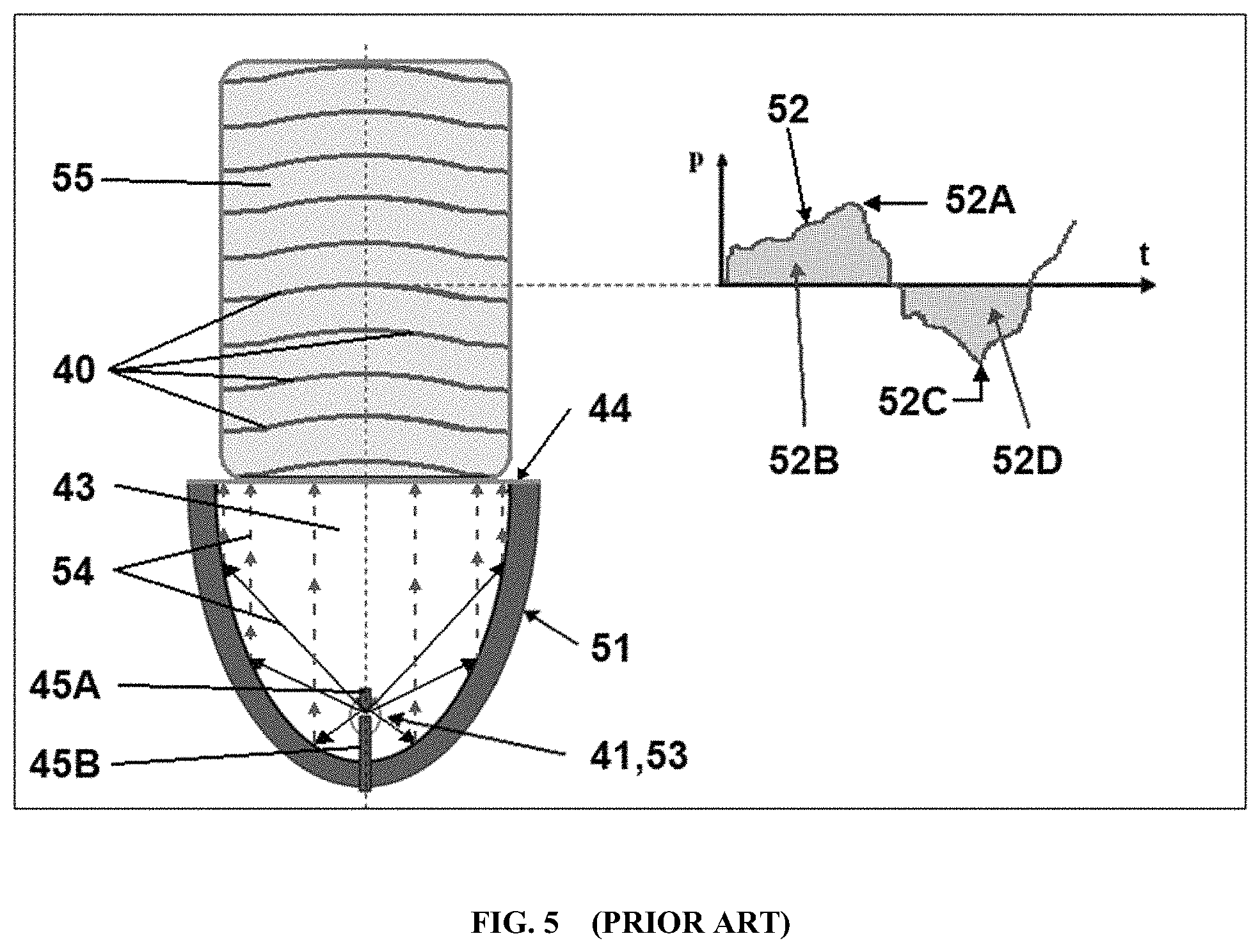 Patent US11771781 Figure 5 – Reprocessing of contaminated reusable devices with direct contact of pressure waves