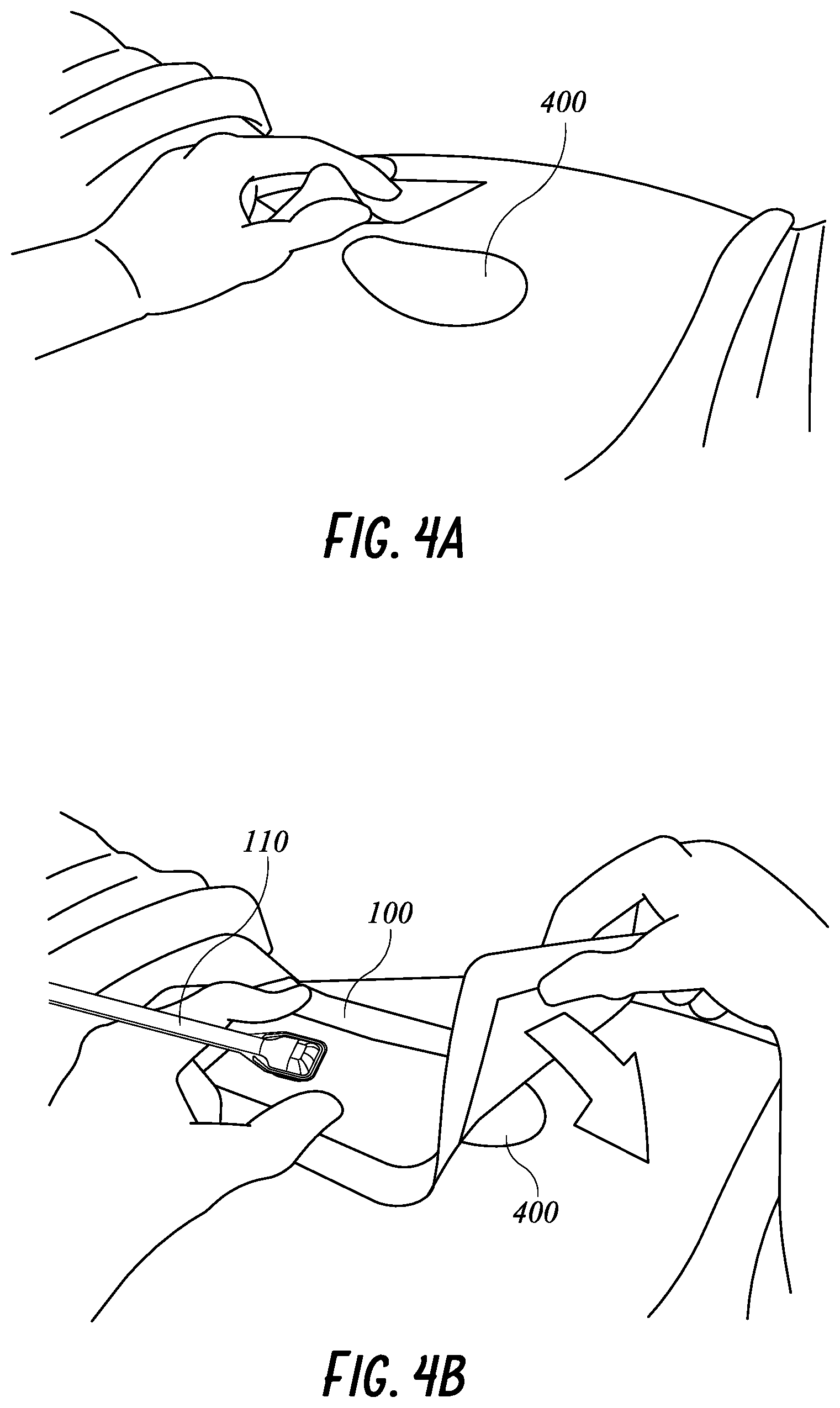 Patent US11771820 Figure 10 – Negative pressure wound therapy apparatus for post breast surgery wounds