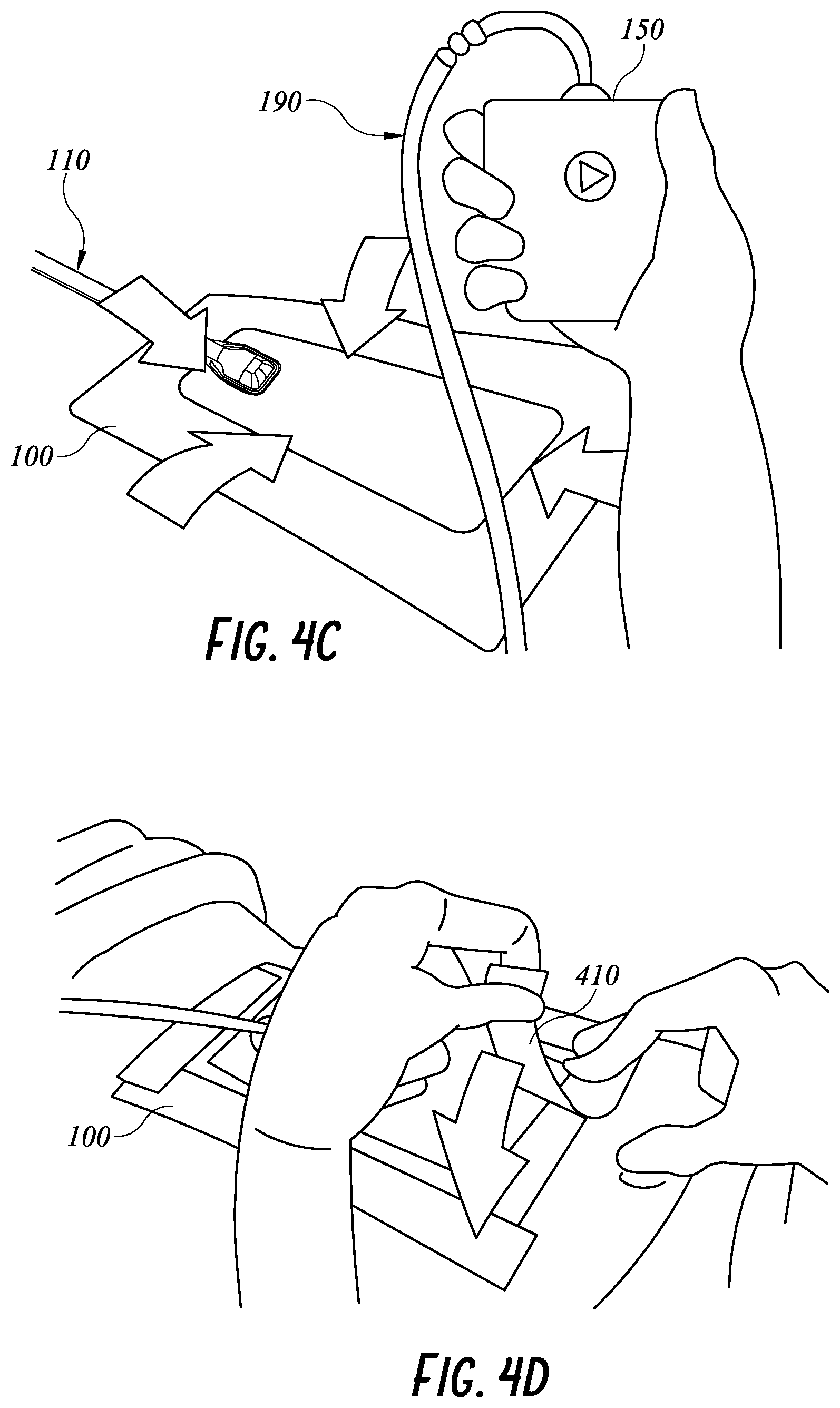 Patent US11771820 Figure 11 – Negative pressure wound therapy apparatus for post breast surgery wounds