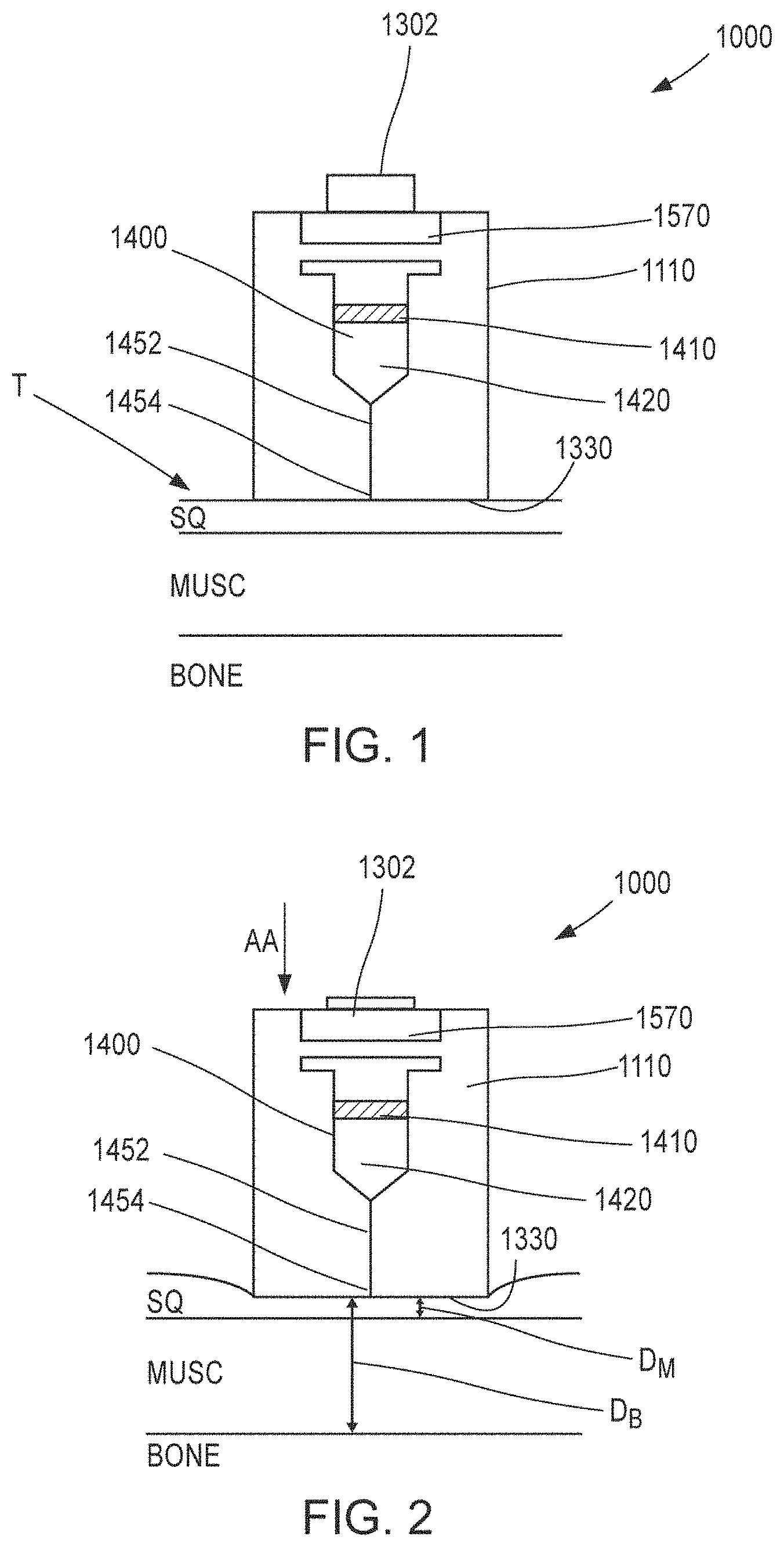 Patent US11771830 Figure 1 – Medicament delivery device and methods for delivering drugs to infants and children
