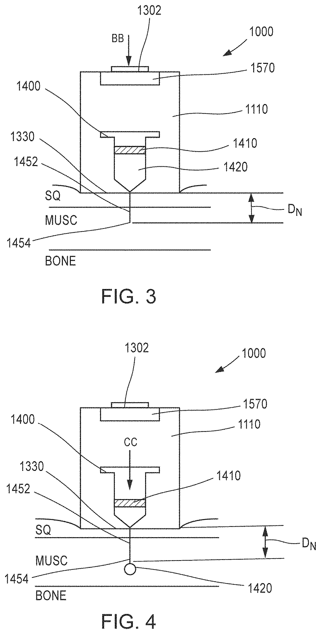 Patent US11771830 Figure 2 – Medicament delivery device and methods for delivering drugs to infants and children