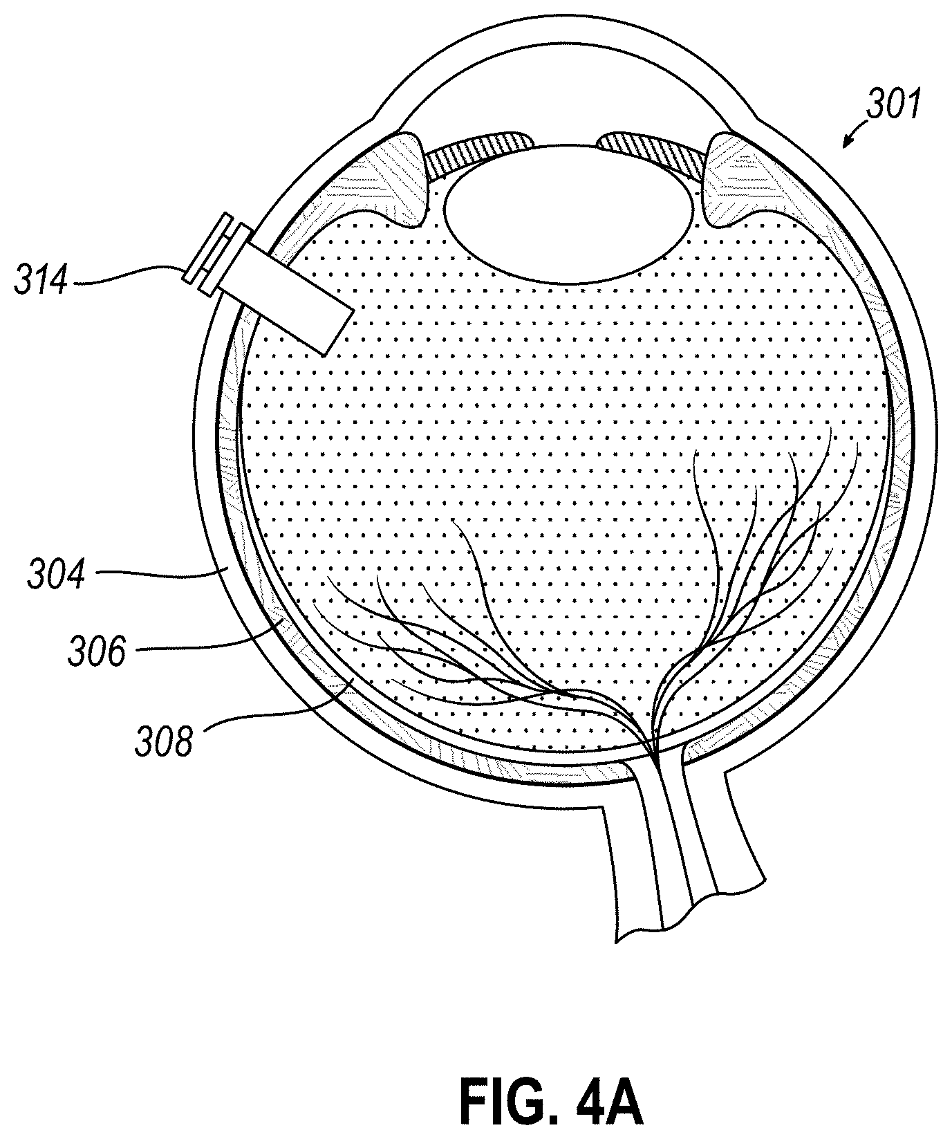 Patent US11771834 Figure 4 – Dose clip assembly for syringe