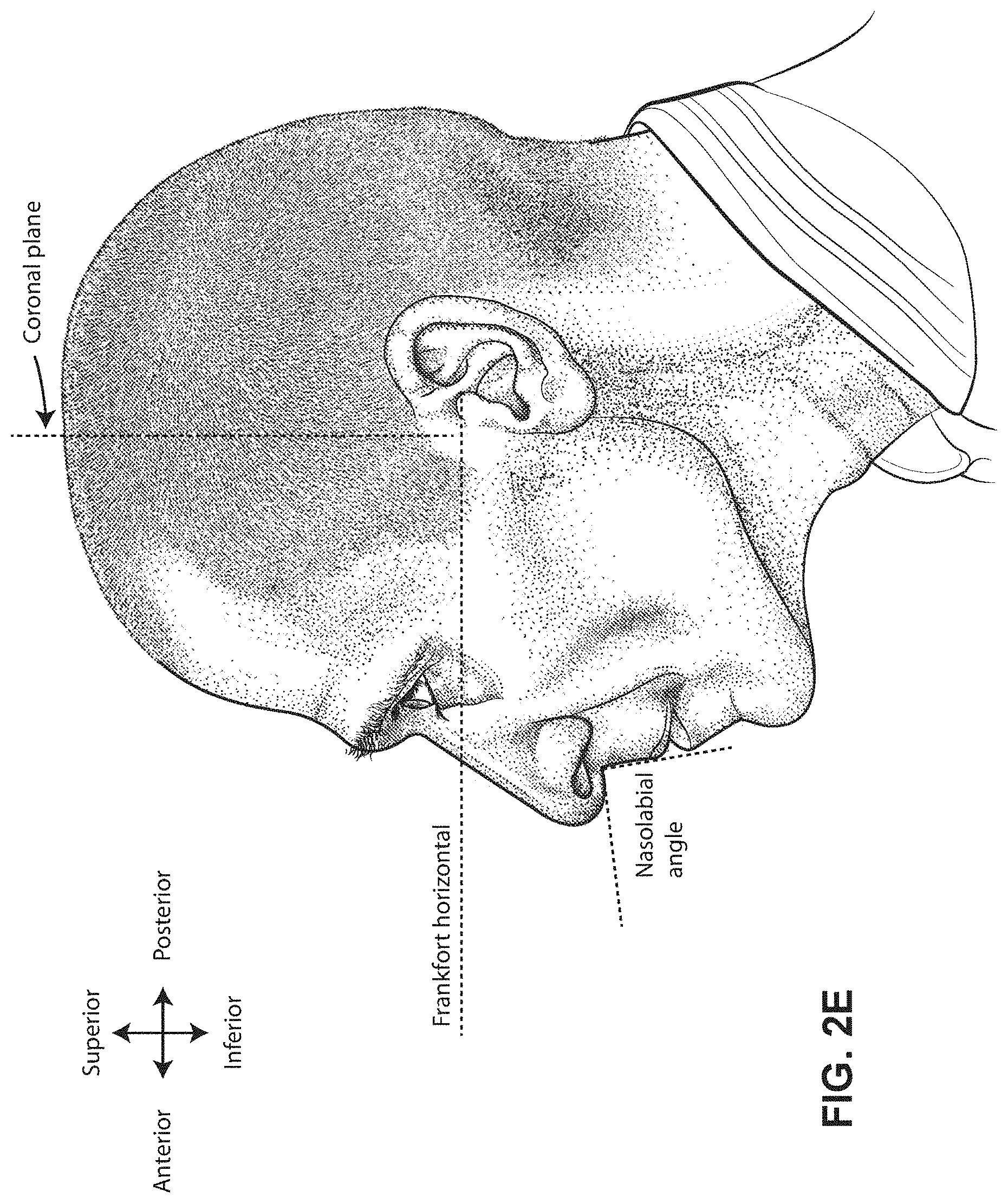 Patent US11771862 Figure 8 – Patient interface