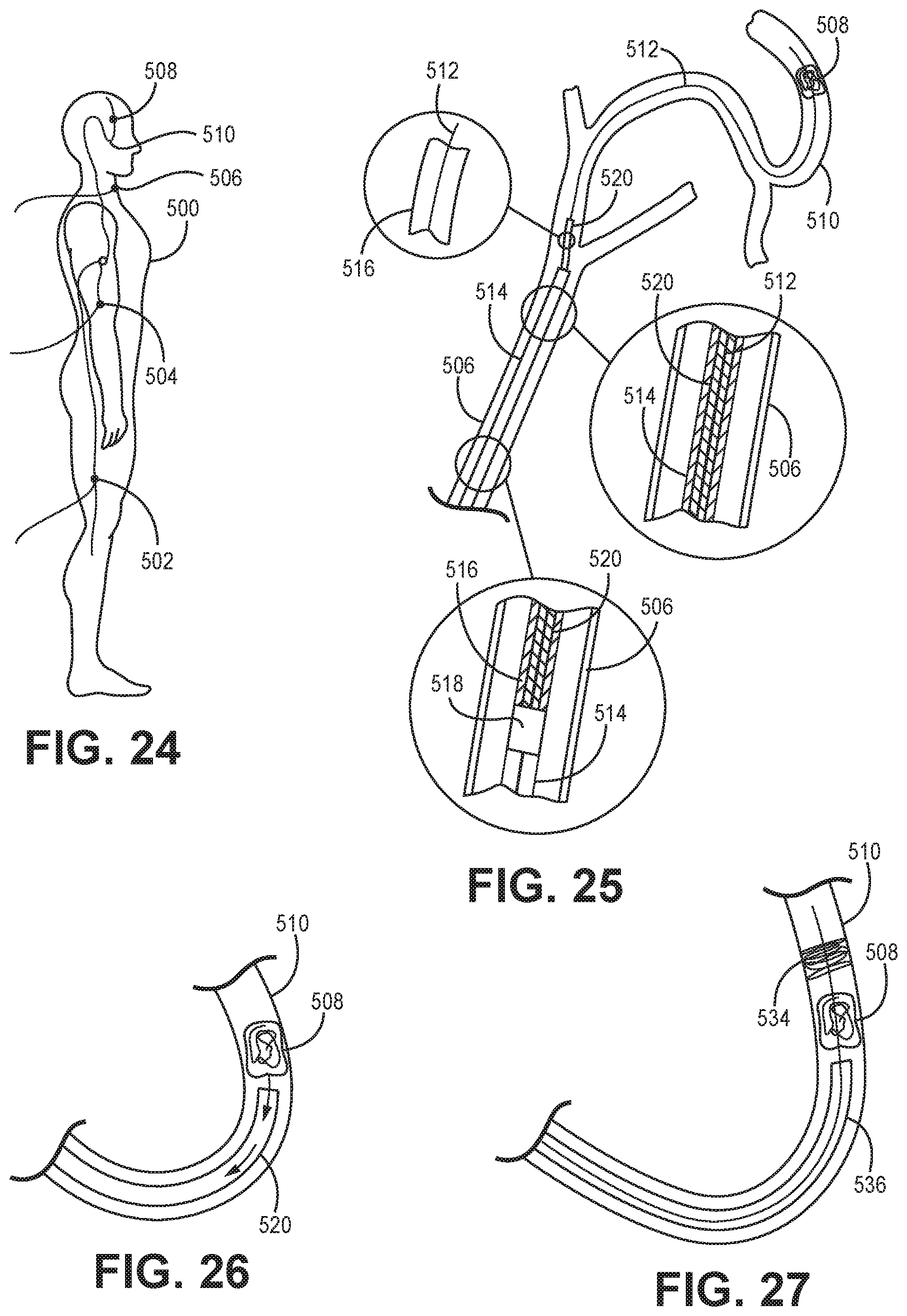 Patent US11771867 Figure 8 – Suction catheter systems for applying effective aspiration in remote vessels, especially cerebral arteries