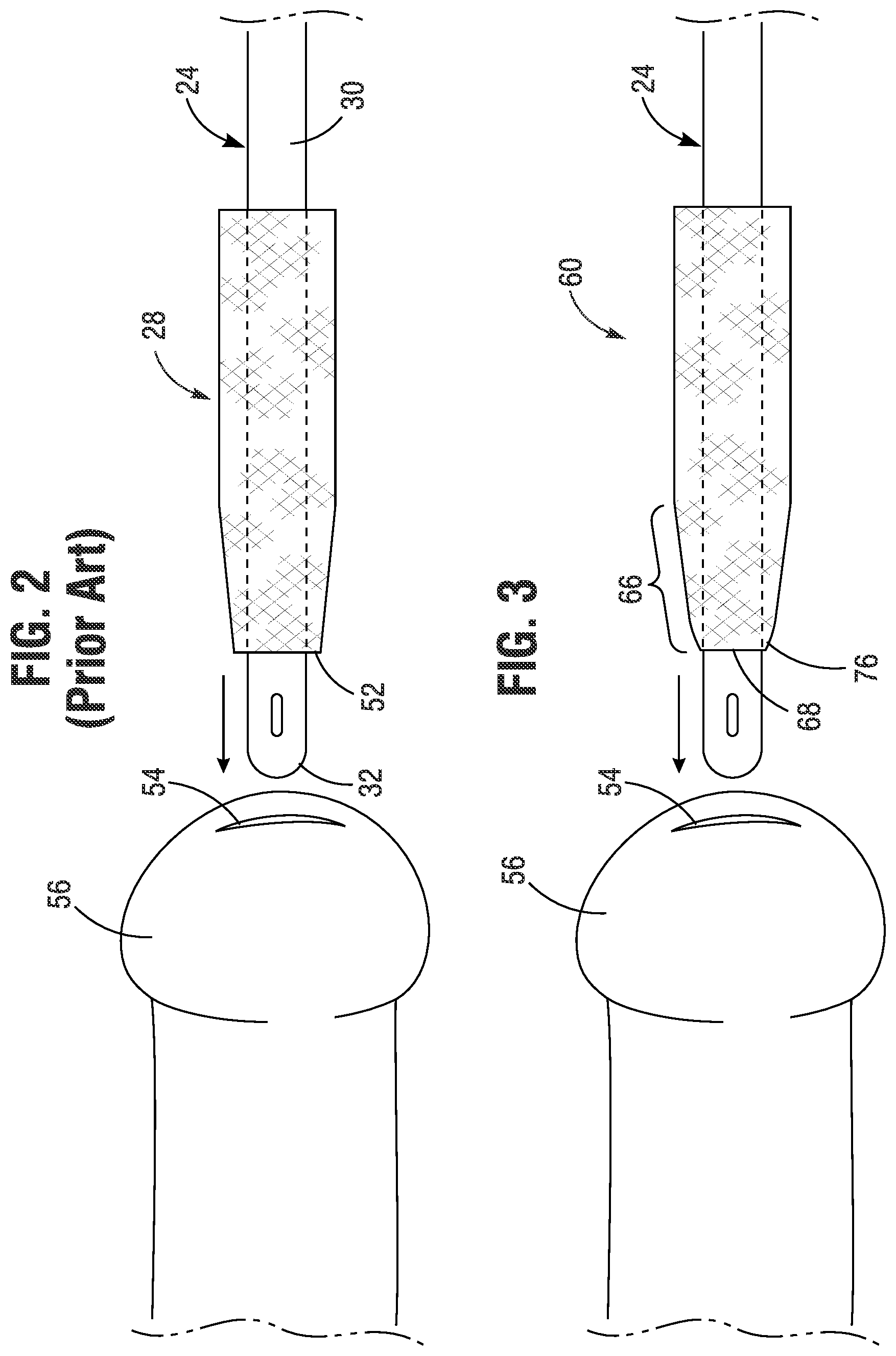 Patent US11771868 Figure 2 – Gripper sleeve for urinary catheter