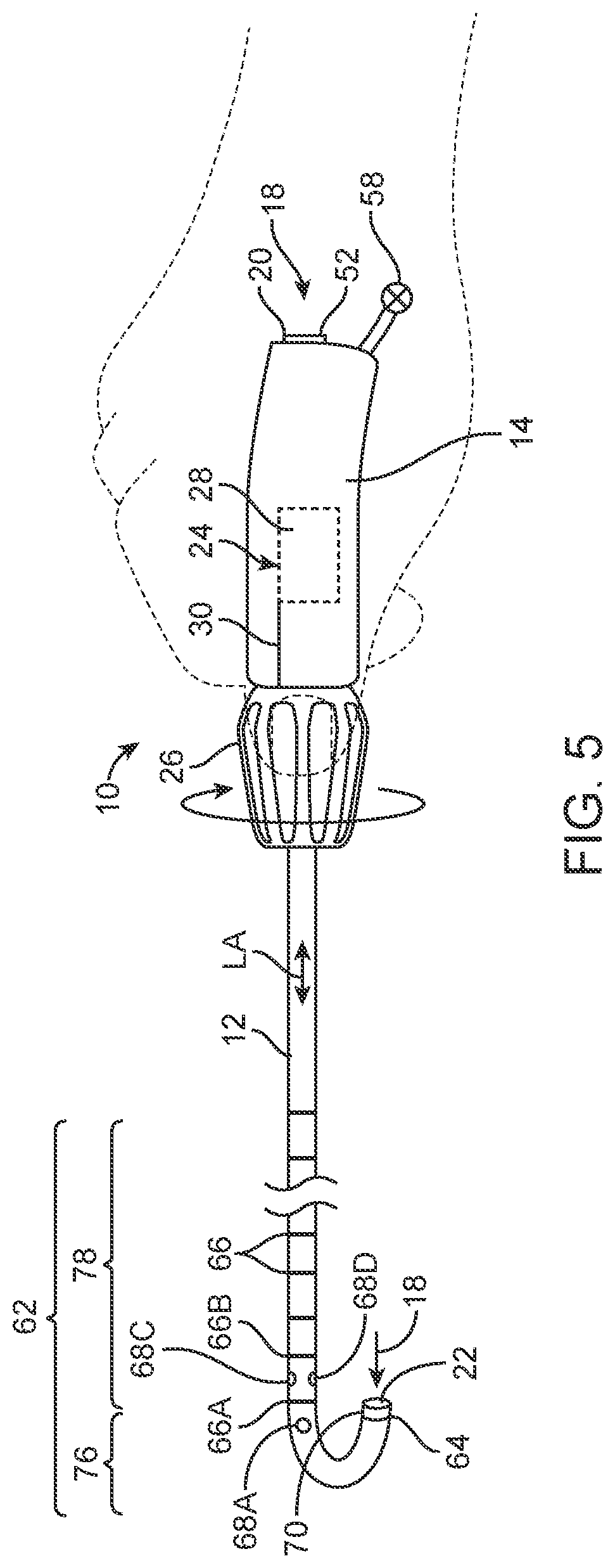 Patent US11771870 Figure 2 – Vector flush sizing catheter and method