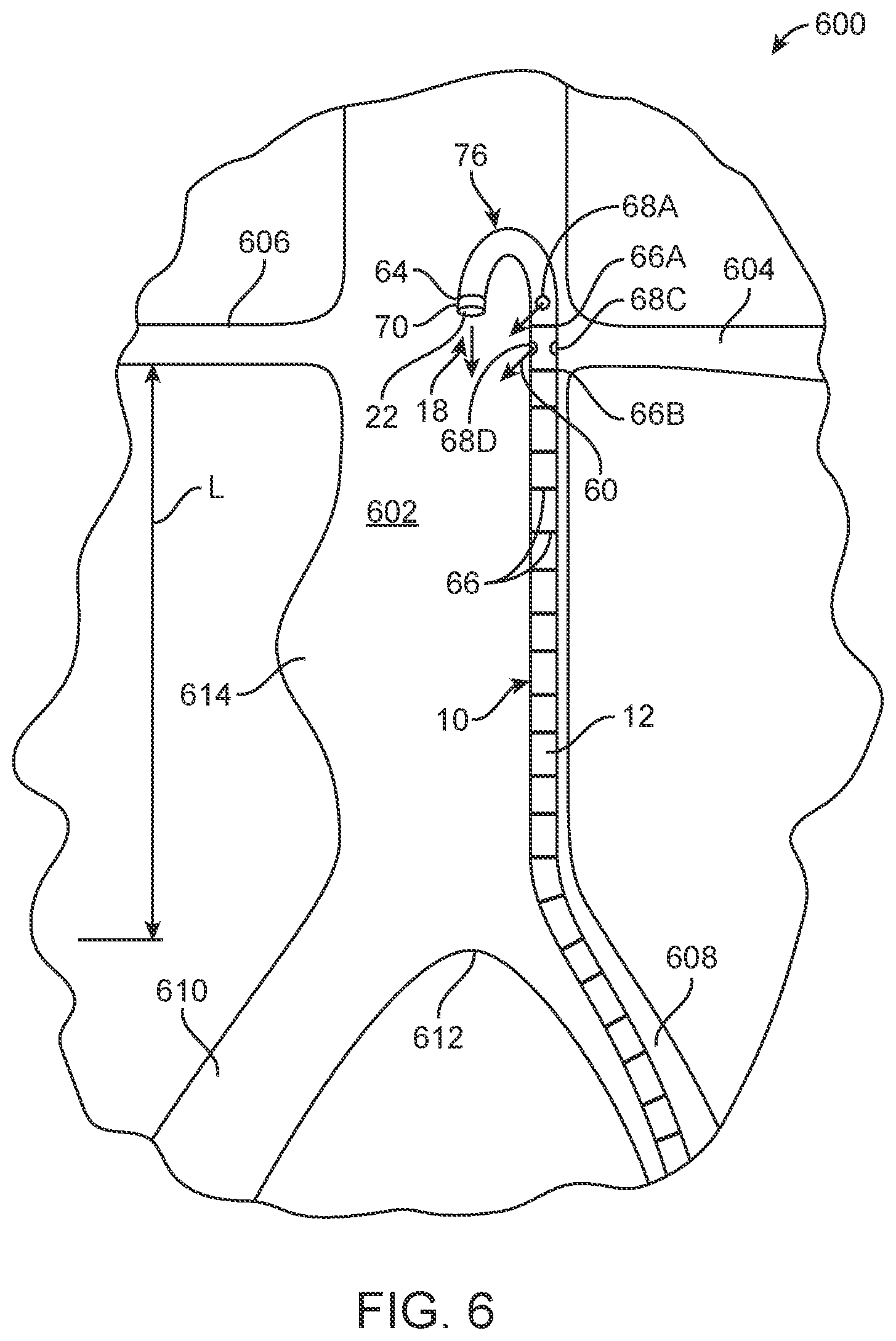 Patent US11771870 Figure 3 – Vector flush sizing catheter and method