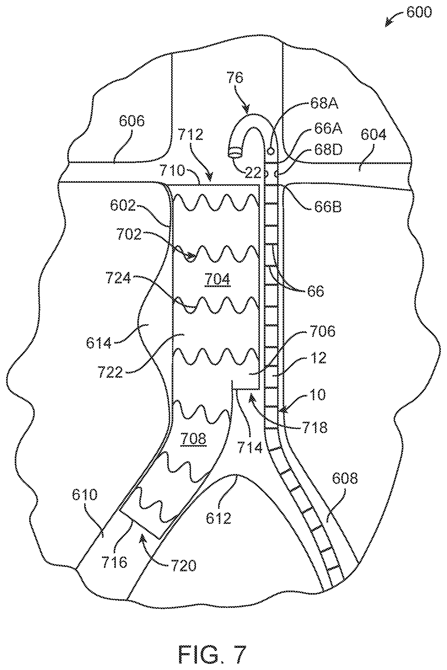 Patent US11771870 Figure 4 – Vector flush sizing catheter and method