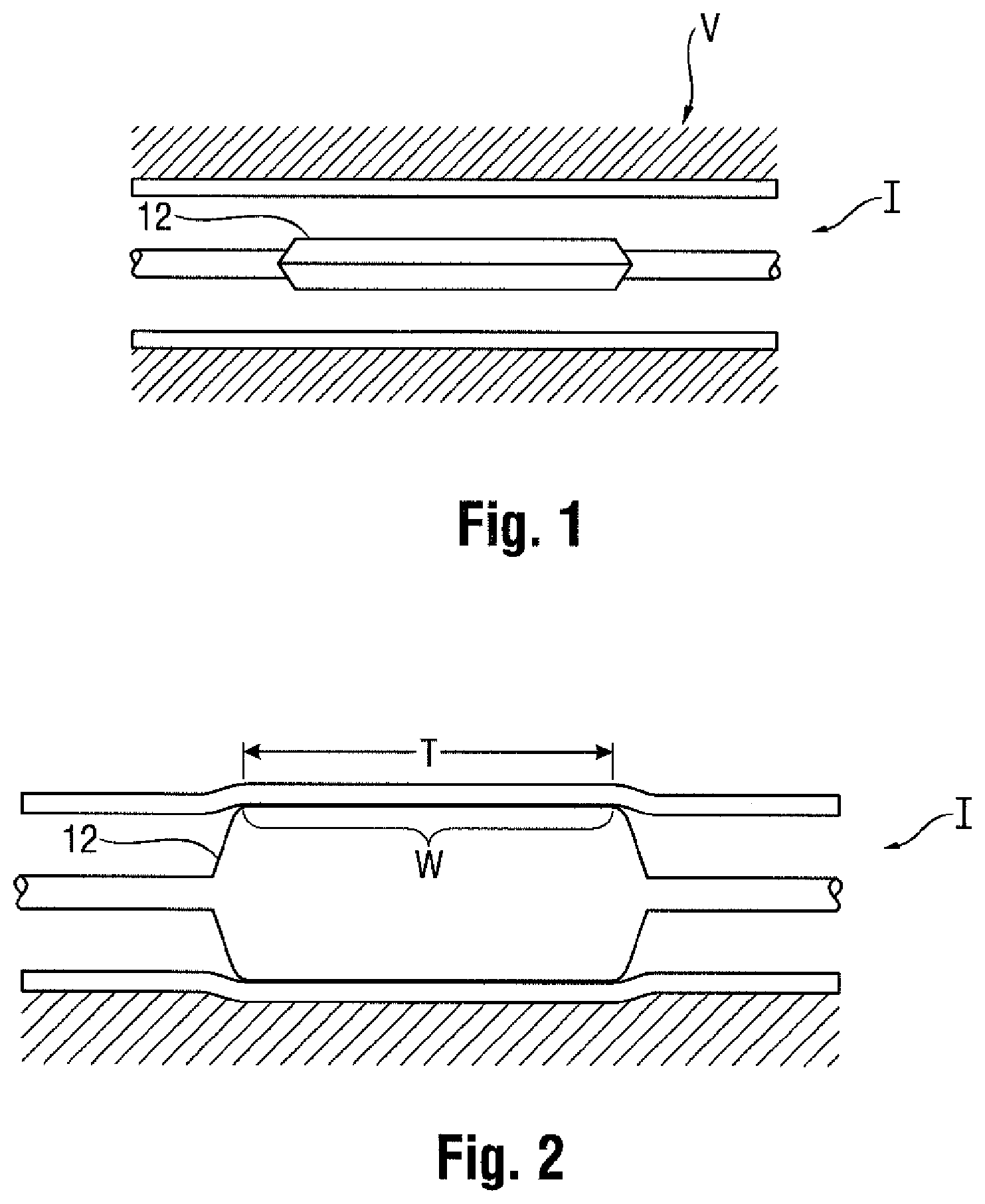 Patent US11771873 Figure 1 – Medical balloon with radiopaque identifier for precisely identifying the working surface