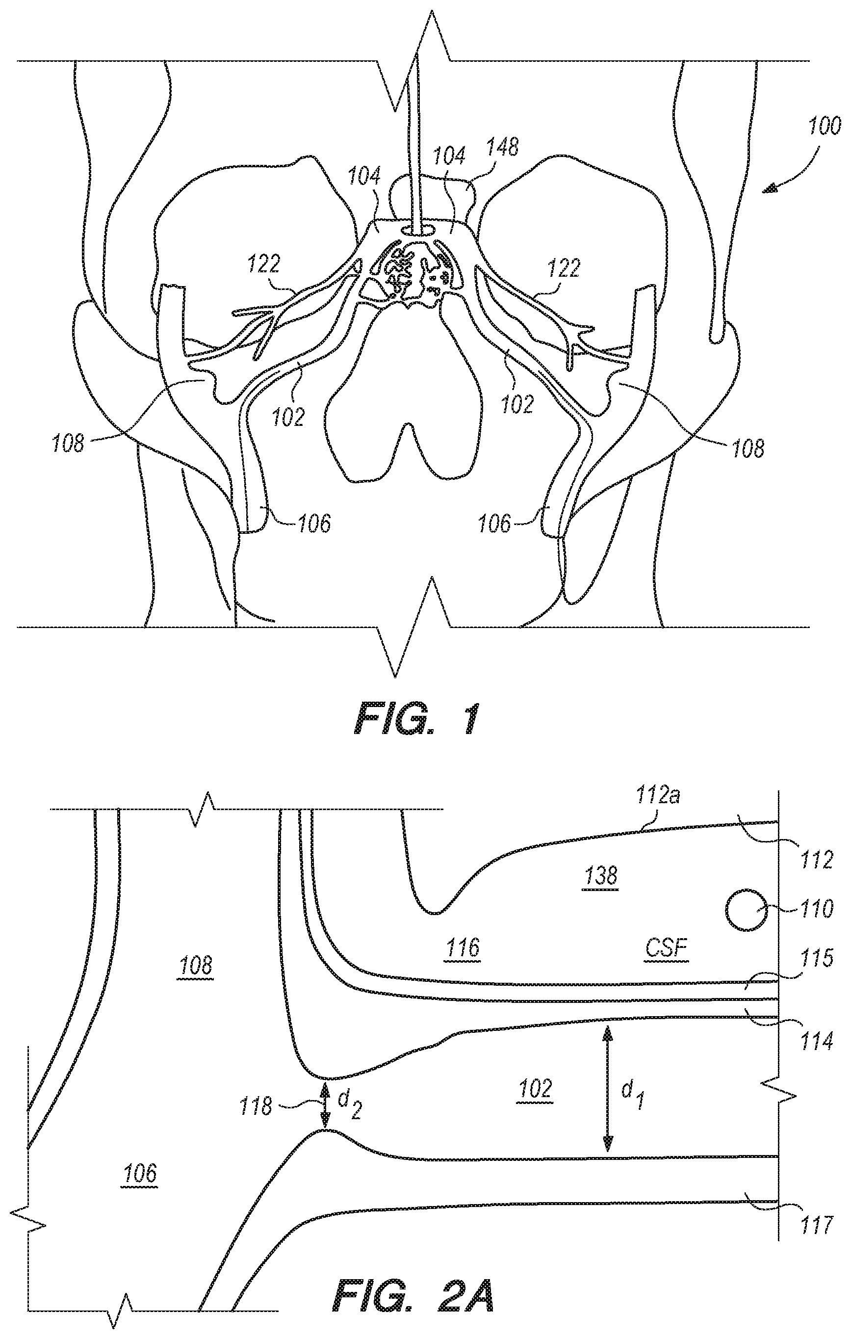Patent US11771875 Figure 1 – Catheter systems and methods for medical procedures using catheters