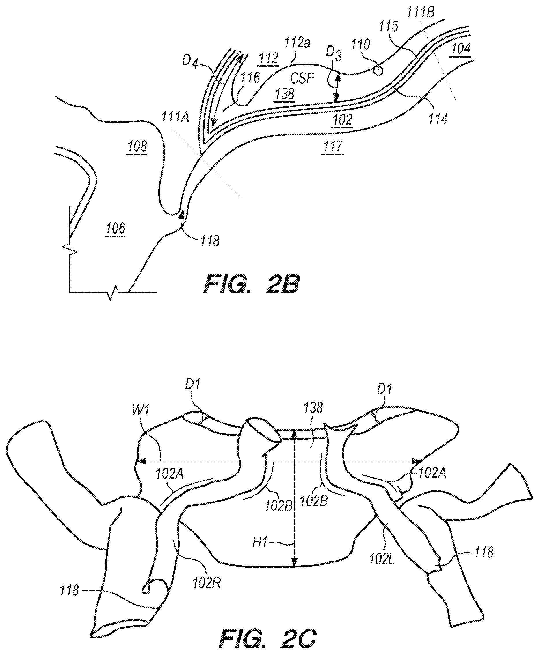 Patent US11771875 Figure 2 – Catheter systems and methods for medical procedures using catheters