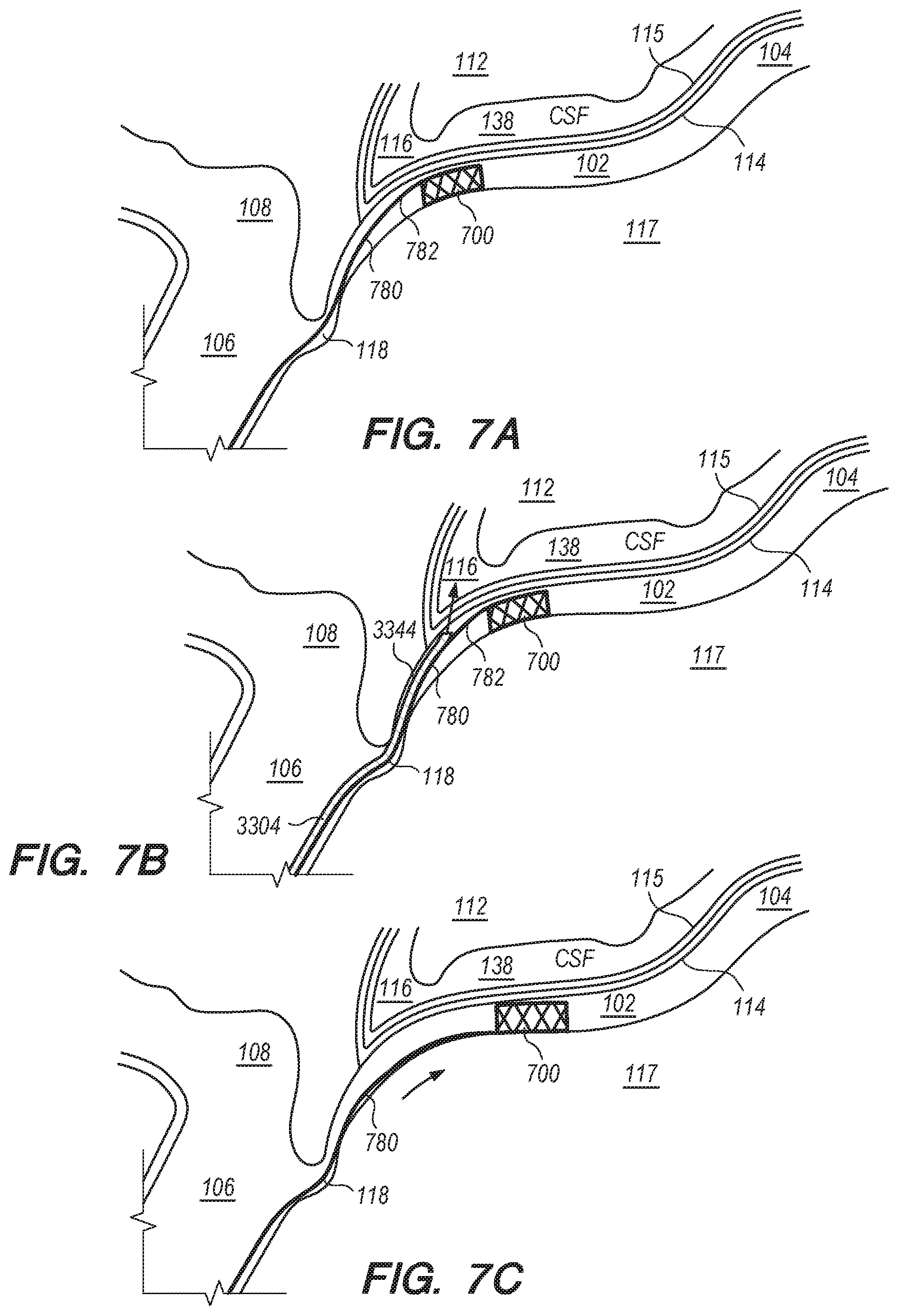Patent US11771875 Figure 14 – Catheter systems and methods for medical procedures using catheters