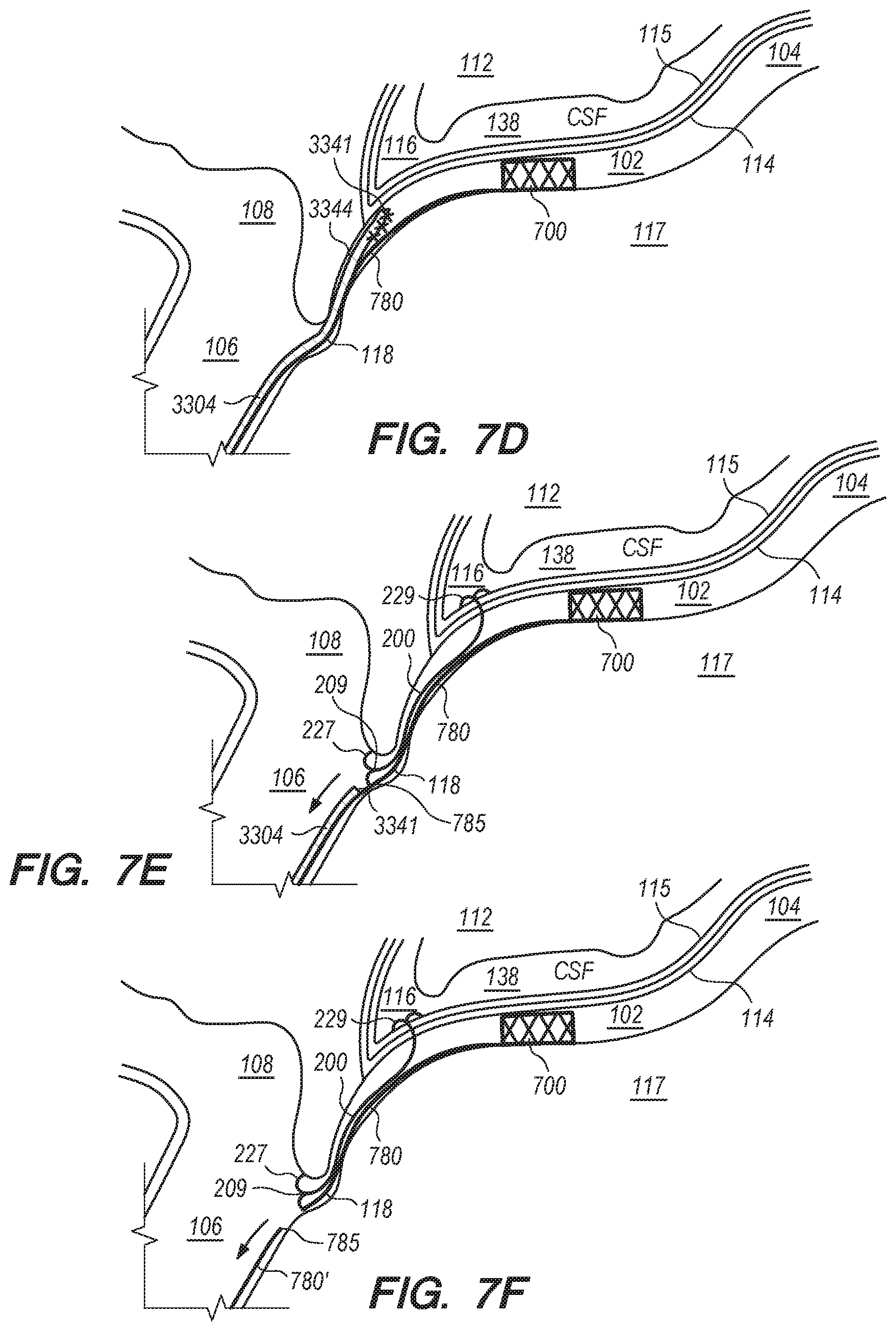 Patent US11771875 Figure 15 – Catheter systems and methods for medical procedures using catheters