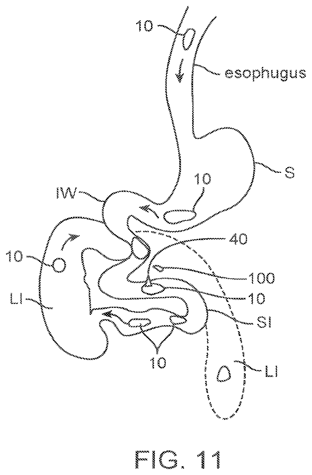 Patent US11771879 Figure 17 – Therapeutic agent preparations for delivery into a lumen of the intestinal tract using a swallowable drug delivery device