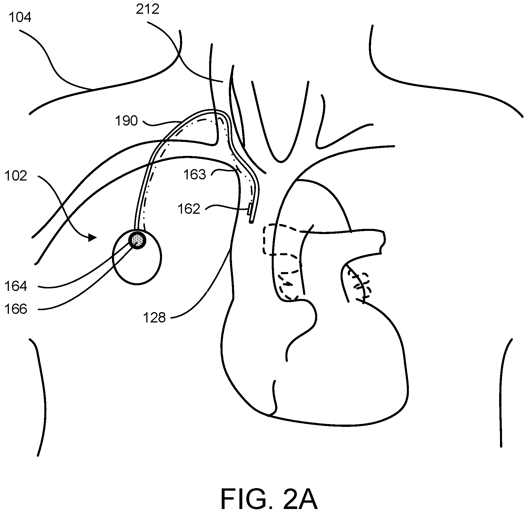 Patent US11771880 Figure 4 – Implantable venous access port with remote physiological monitoring capabilities