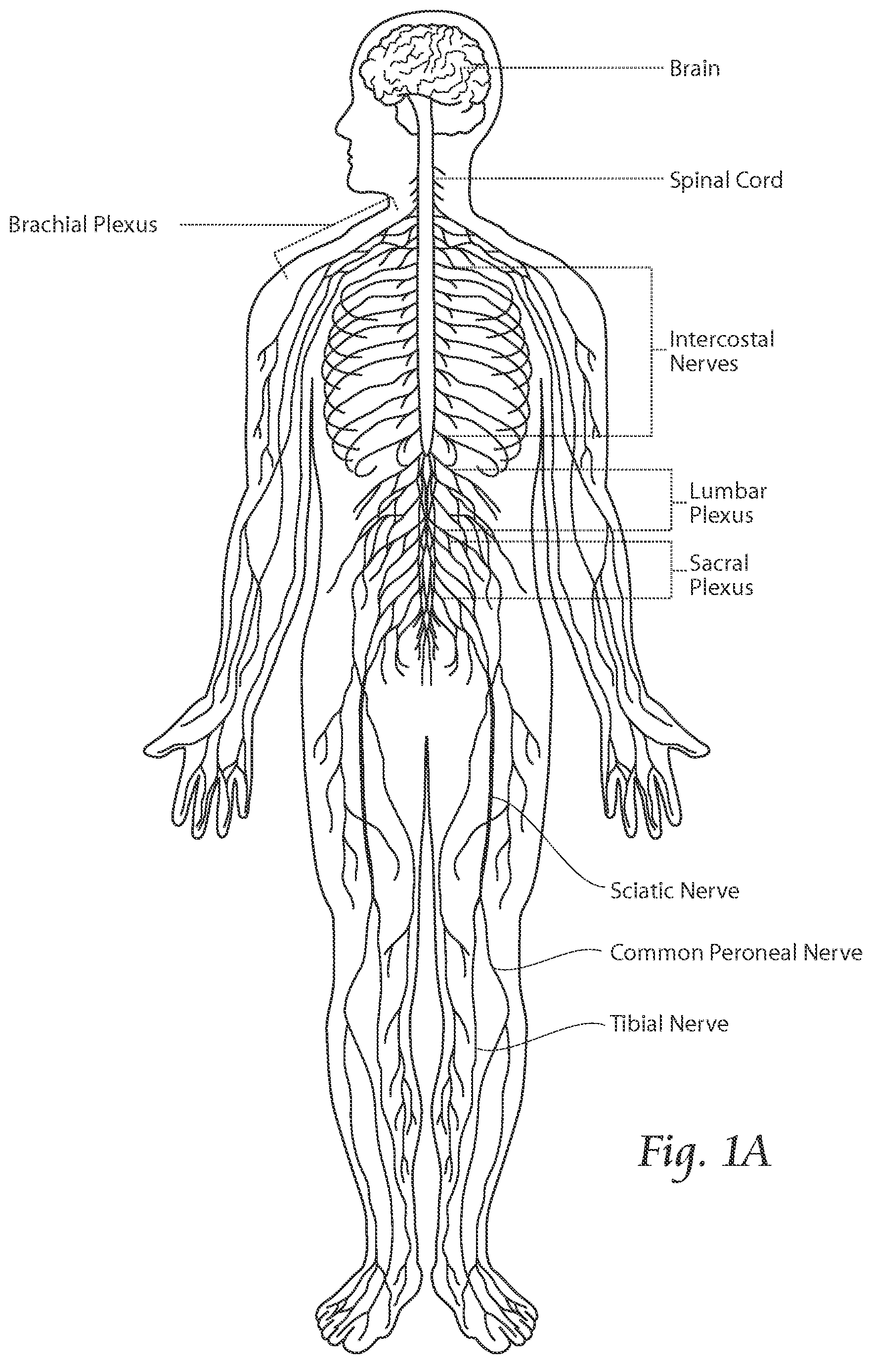 Patent US11771891 Figure 1 – Systems and methods to place one or more leads in tissue to electrically stimulate nerves of passage to treat pain