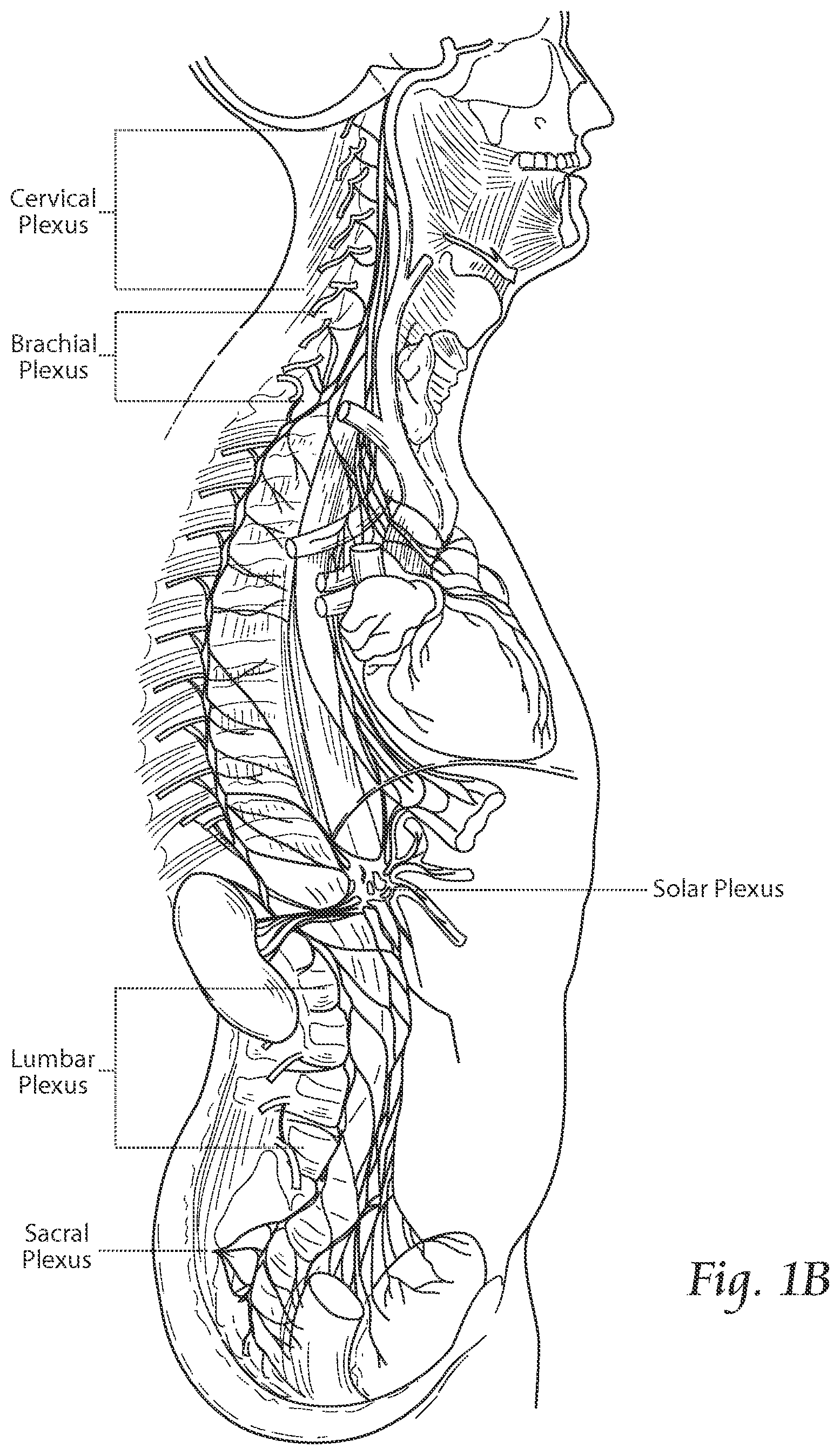 Patent US11771891 Figure 2 – Systems and methods to place one or more leads in tissue to electrically stimulate nerves of passage to treat pain