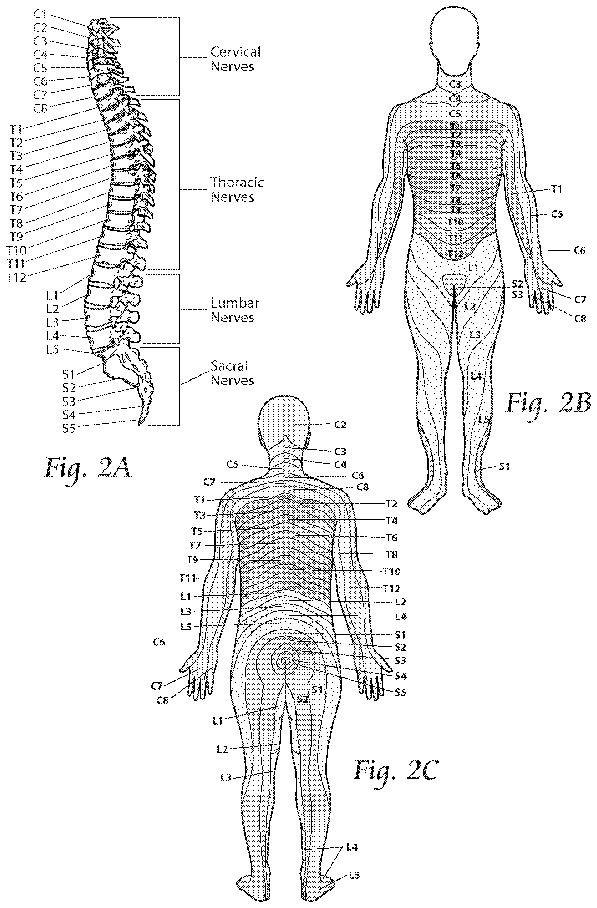 Patent US11771891 Figure 3 – Systems and methods to place one or more leads in tissue to electrically stimulate nerves of passage to treat pain