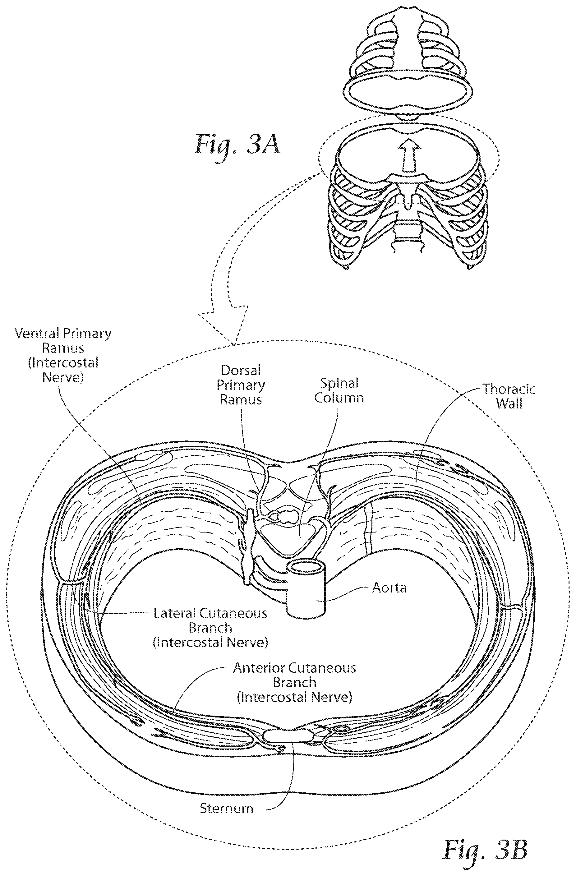 Patent US11771891 Figure 4 – Systems and methods to place one or more leads in tissue to electrically stimulate nerves of passage to treat pain