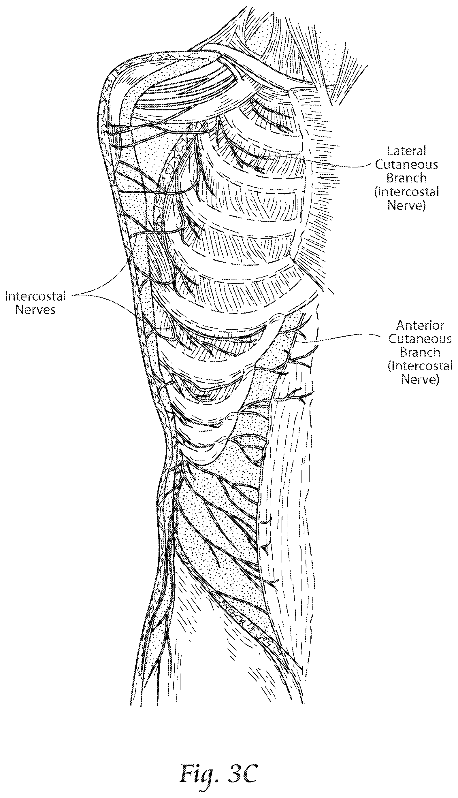Patent US11771891 Figure 5 – Systems and methods to place one or more leads in tissue to electrically stimulate nerves of passage to treat pain