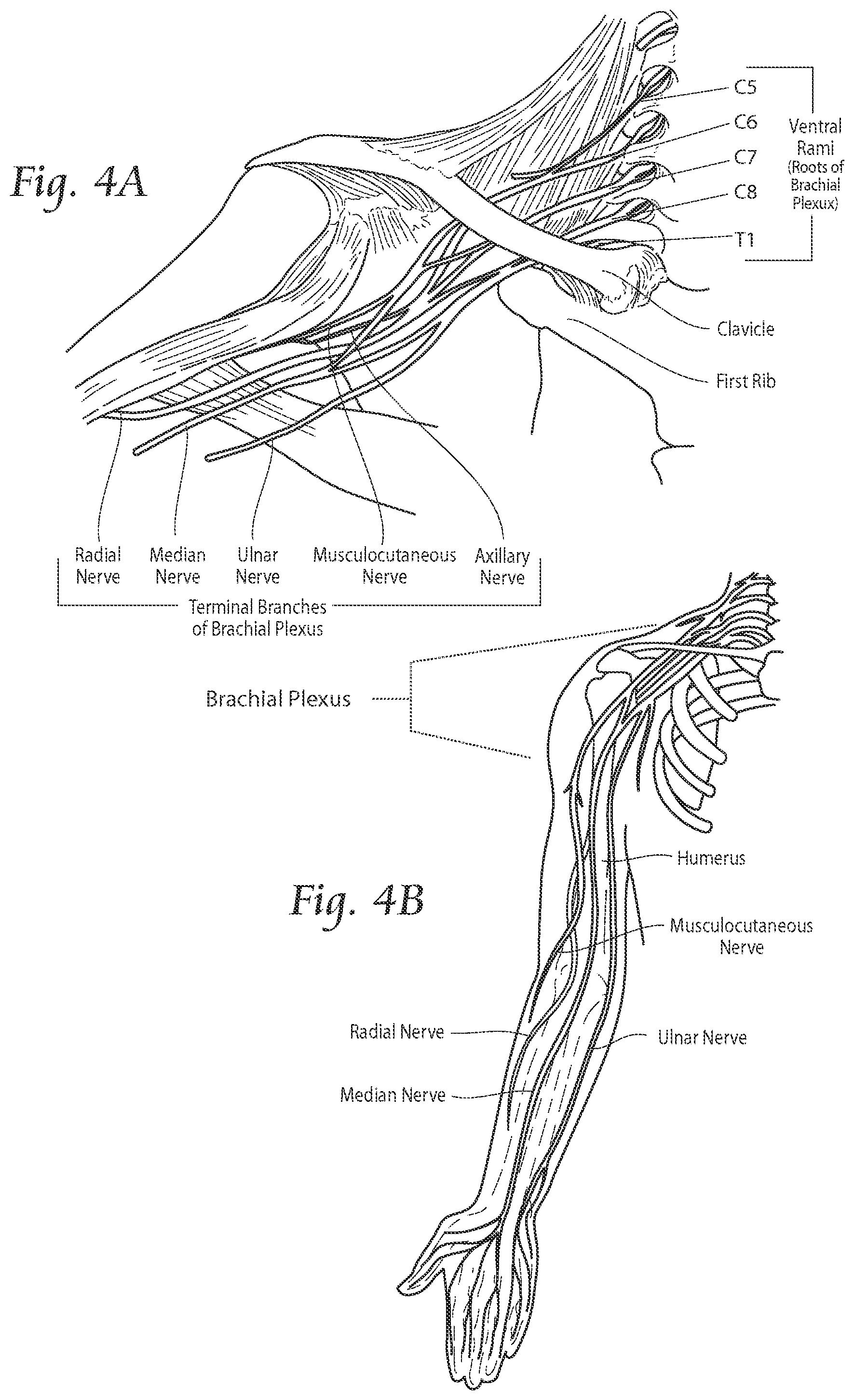 Patent US11771891 Figure 6 – Systems and methods to place one or more leads in tissue to electrically stimulate nerves of passage to treat pain