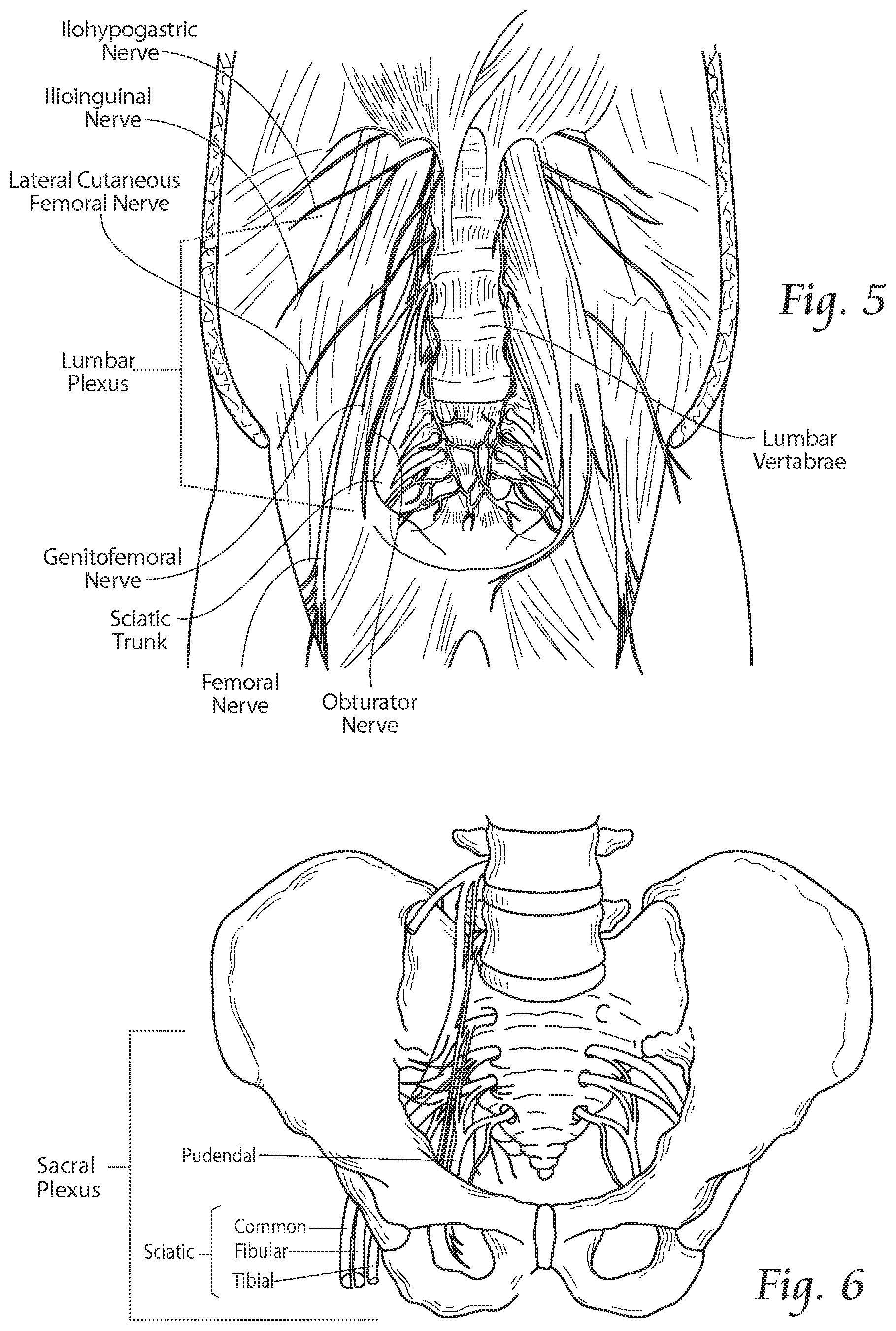 Patent US11771891 Figure 7 – Systems and methods to place one or more leads in tissue to electrically stimulate nerves of passage to treat pain