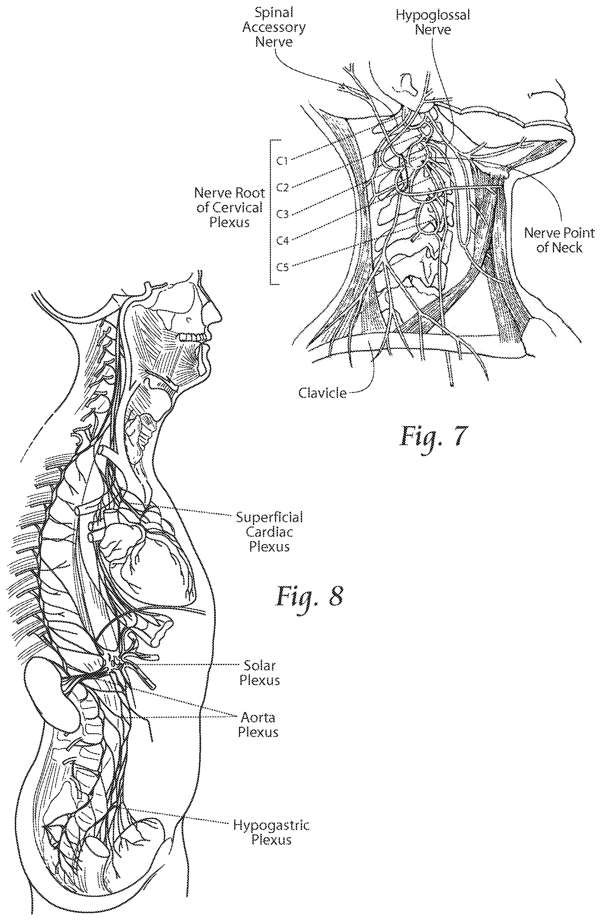 Patent US11771891 Figure 8 – Systems and methods to place one or more leads in tissue to electrically stimulate nerves of passage to treat pain