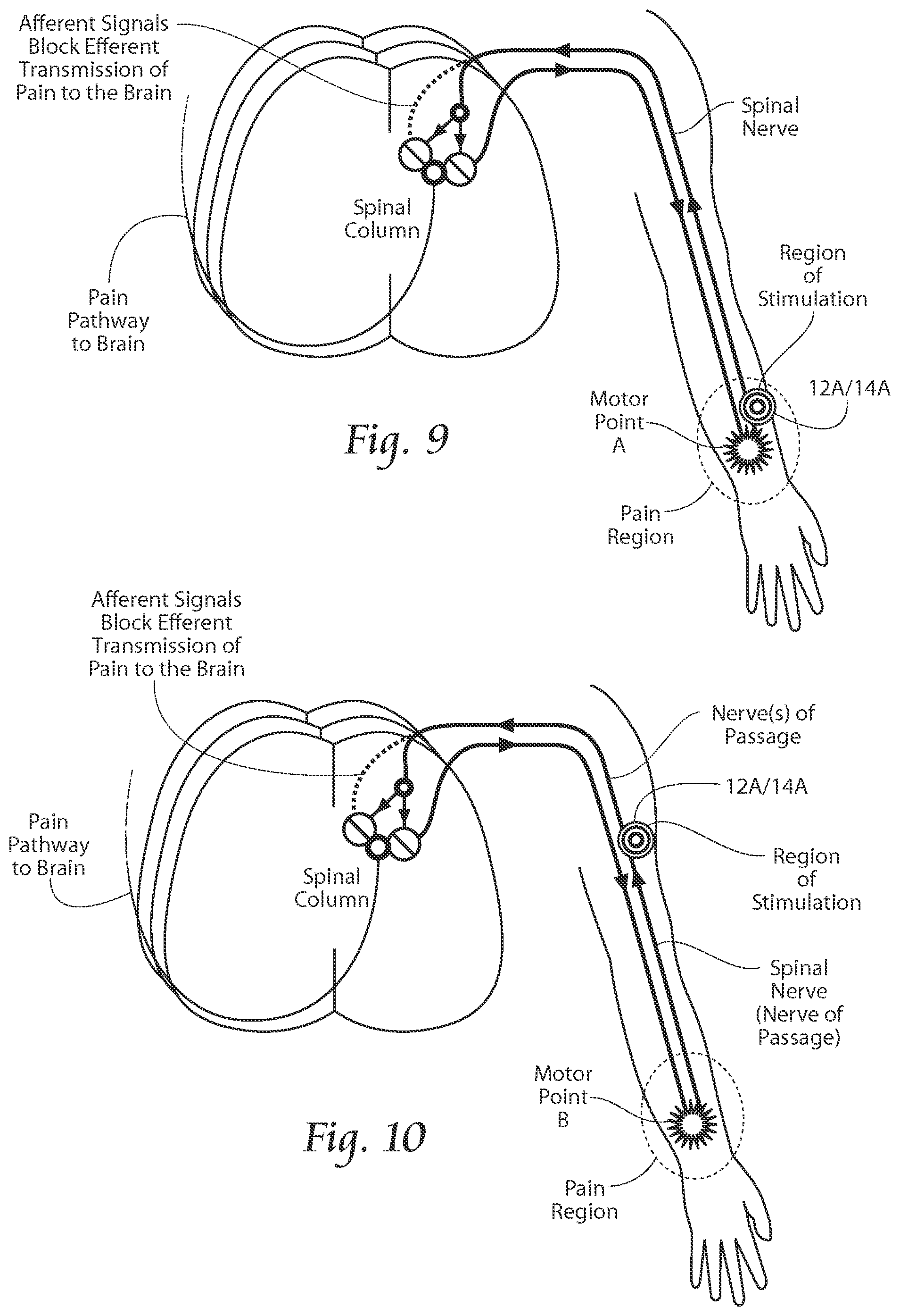 Patent US11771891 Figure 9 – Systems and methods to place one or more leads in tissue to electrically stimulate nerves of passage to treat pain