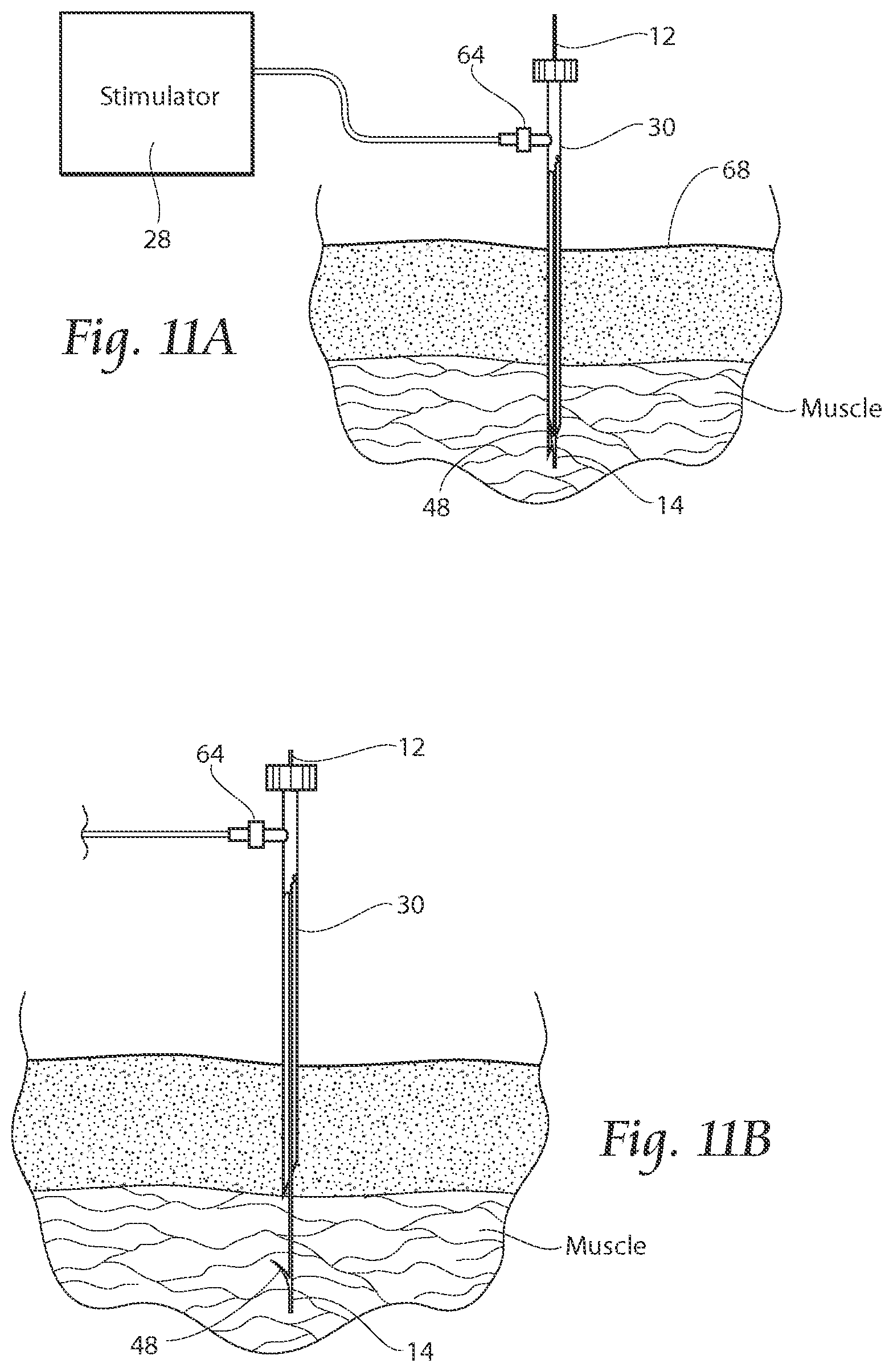 Patent US11771891 Figure 10 – Systems and methods to place one or more leads in tissue to electrically stimulate nerves of passage to treat pain