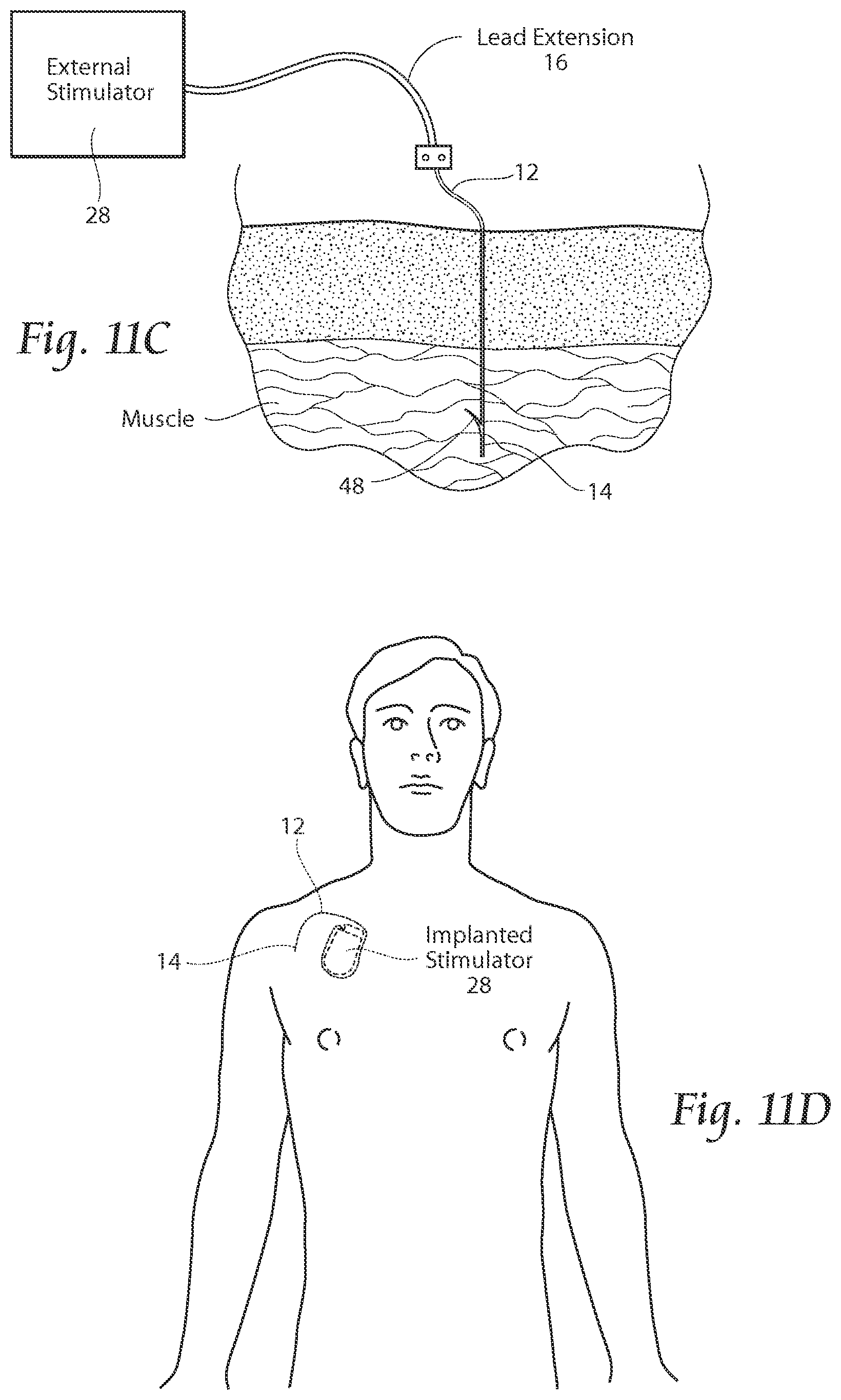 Patent US11771891 Figure 11 – Systems and methods to place one or more leads in tissue to electrically stimulate nerves of passage to treat pain