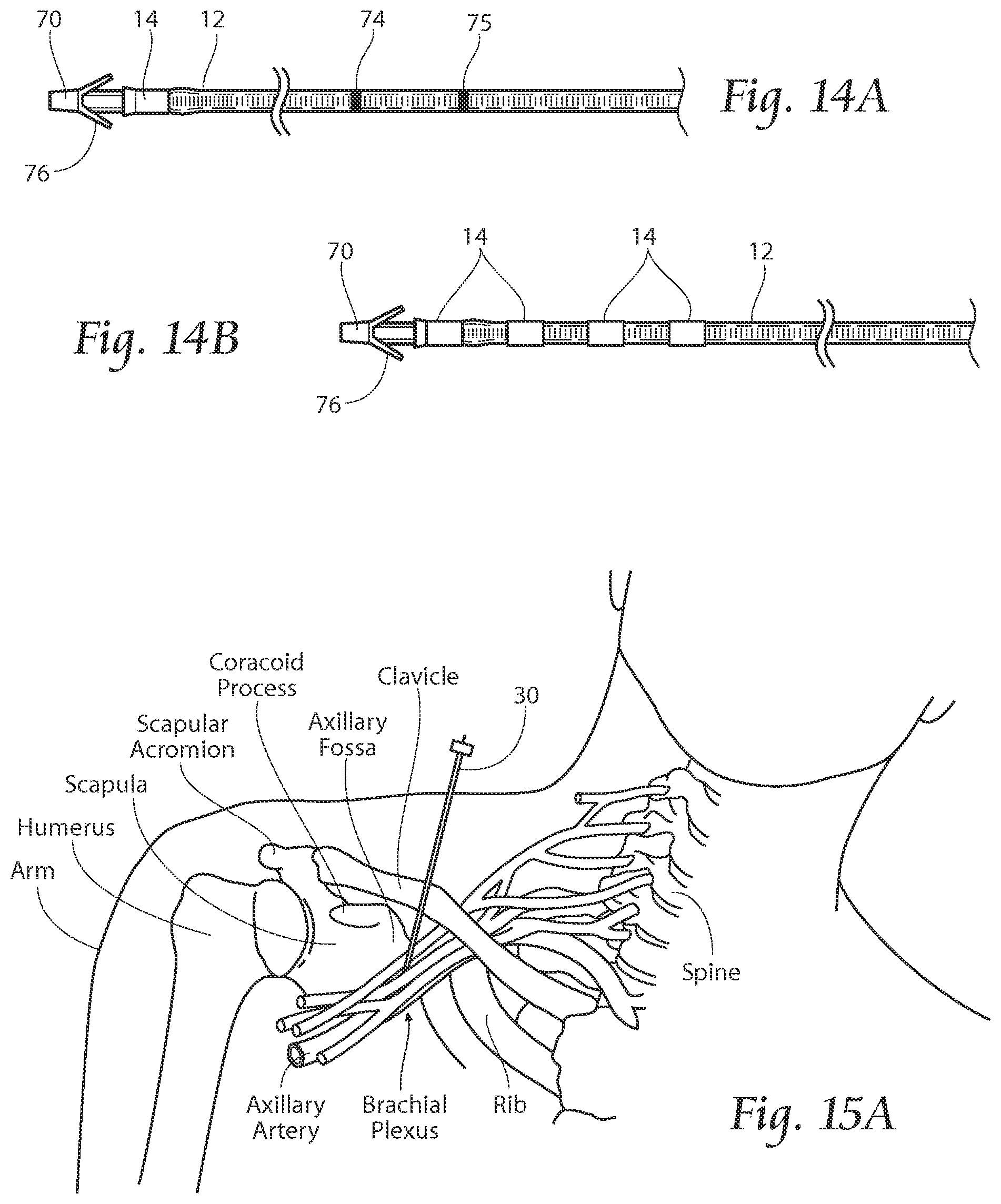 Patent US11771891 Figure 13 – Systems and methods to place one or more leads in tissue to electrically stimulate nerves of passage to treat pain