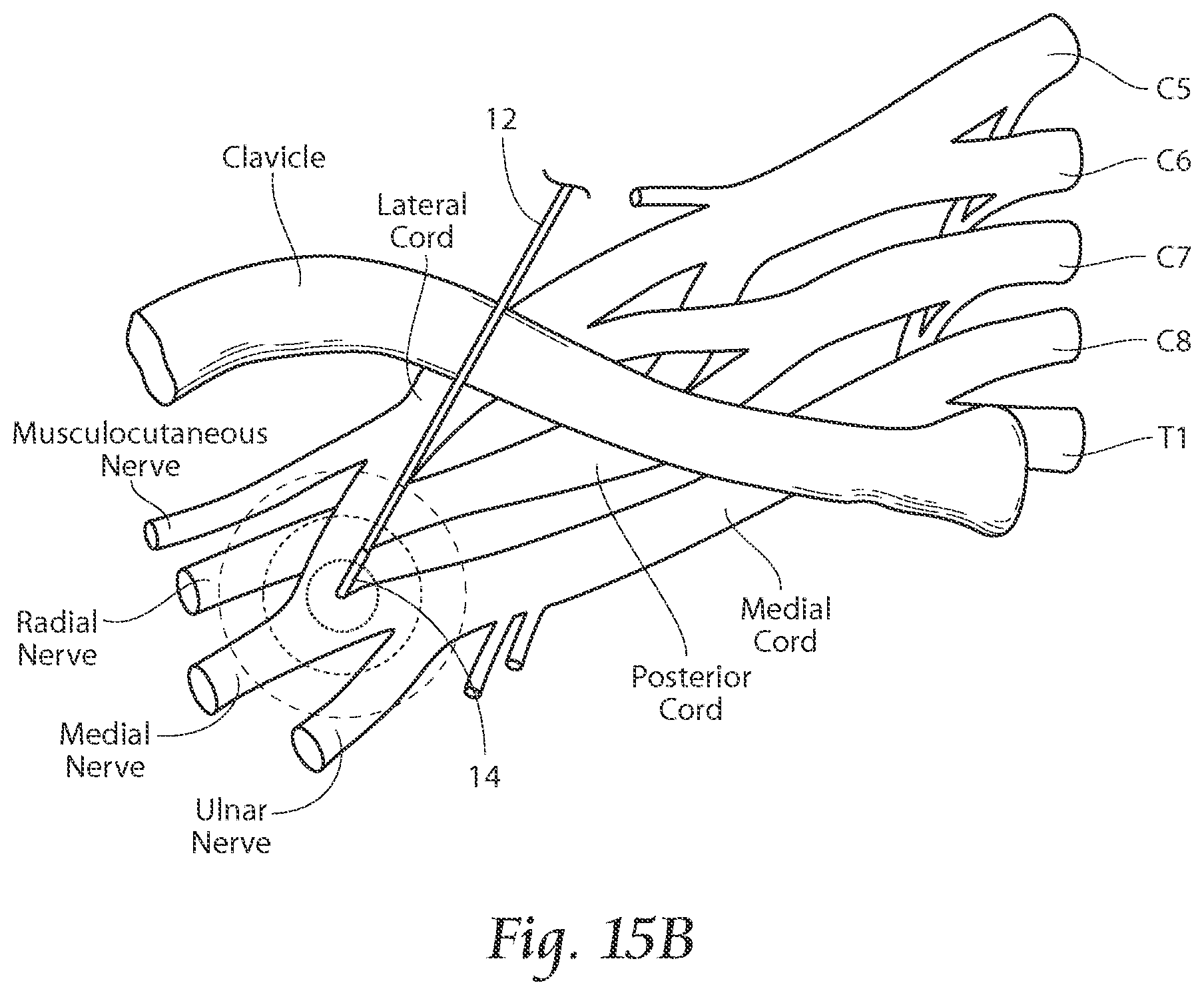 Patent US11771891 Figure 14 – Systems and methods to place one or more leads in tissue to electrically stimulate nerves of passage to treat pain