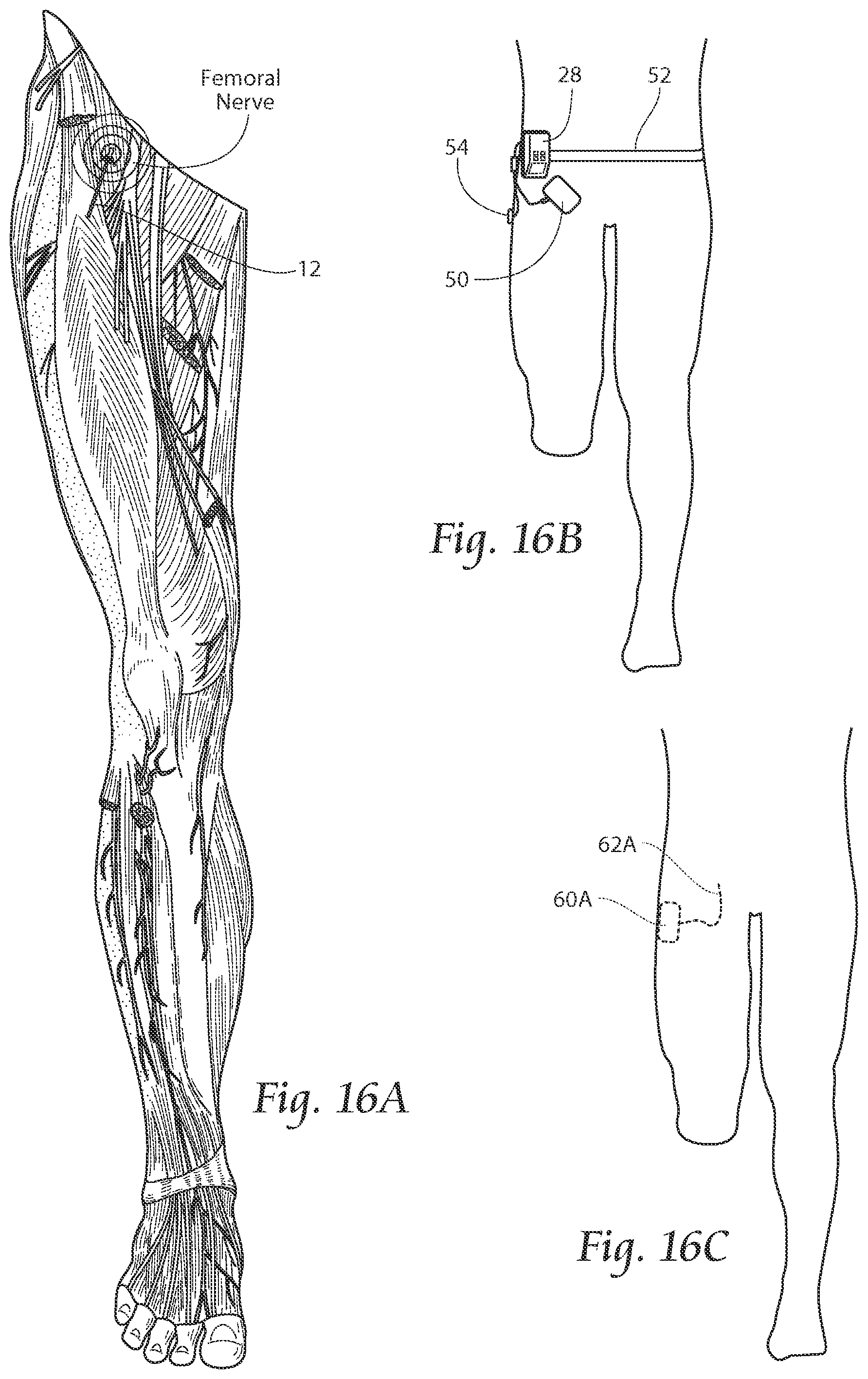 Patent US11771891 Figure 15 – Systems and methods to place one or more leads in tissue to electrically stimulate nerves of passage to treat pain