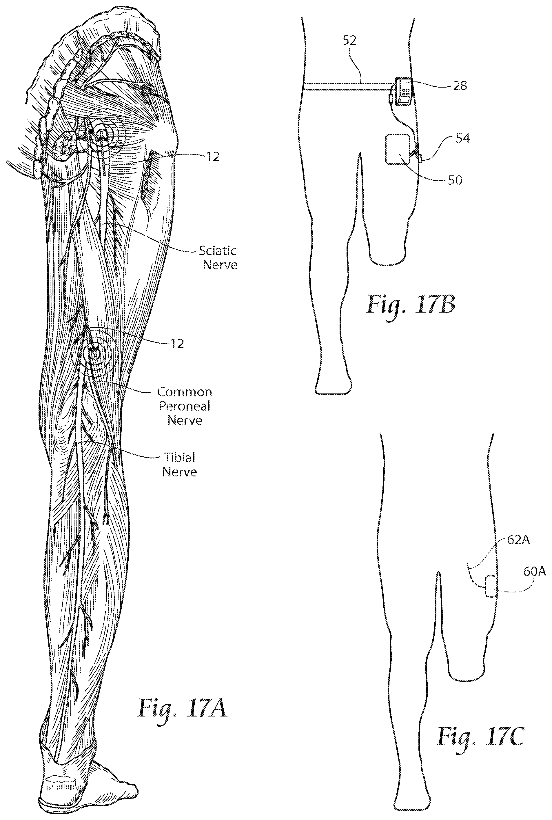 Patent US11771891 Figure 16 – Systems and methods to place one or more leads in tissue to electrically stimulate nerves of passage to treat pain