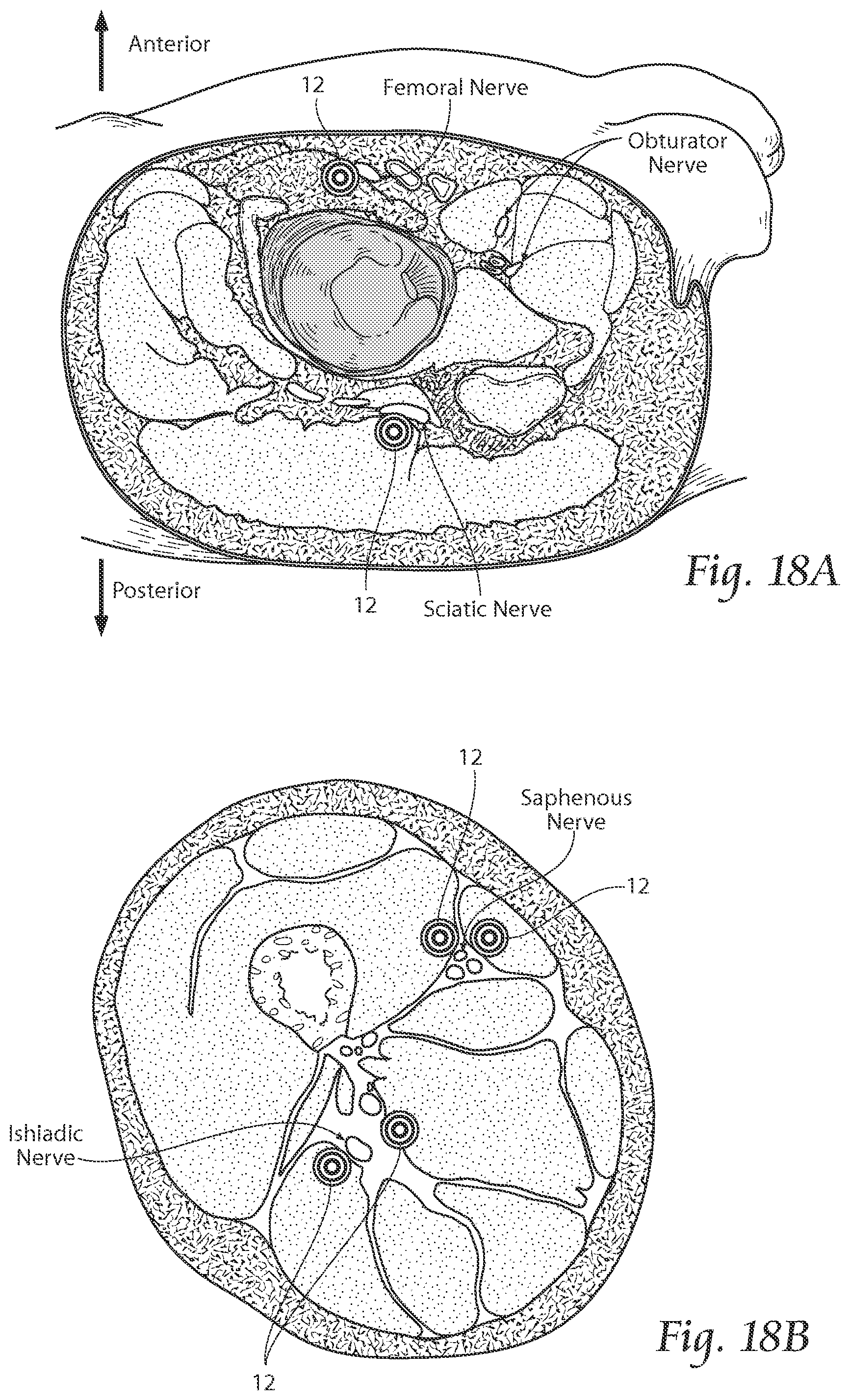 Patent US11771891 Figure 17 – Systems and methods to place one or more leads in tissue to electrically stimulate nerves of passage to treat pain