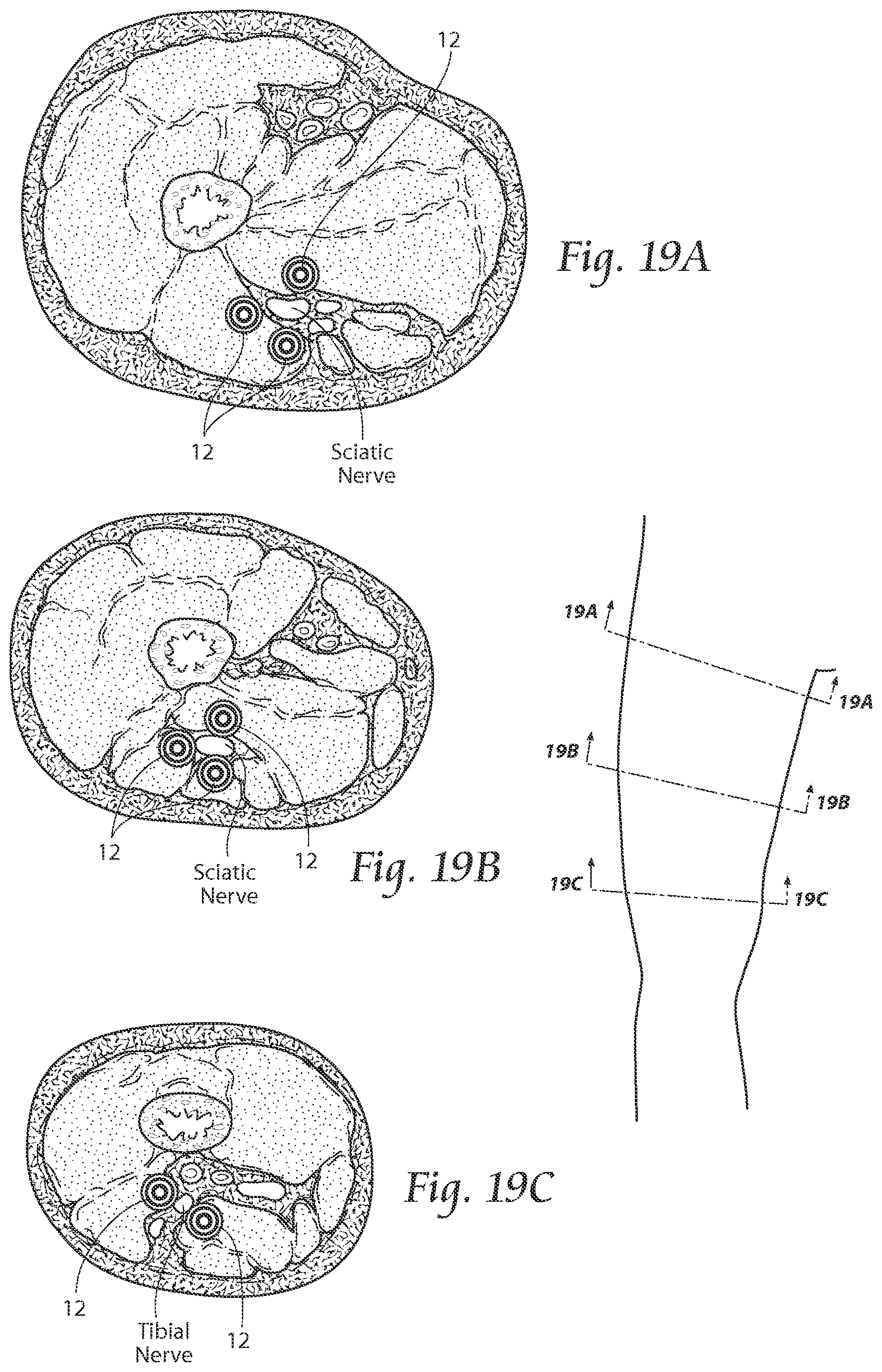 Patent US11771891 Figure 18 – Systems and methods to place one or more leads in tissue to electrically stimulate nerves of passage to treat pain
