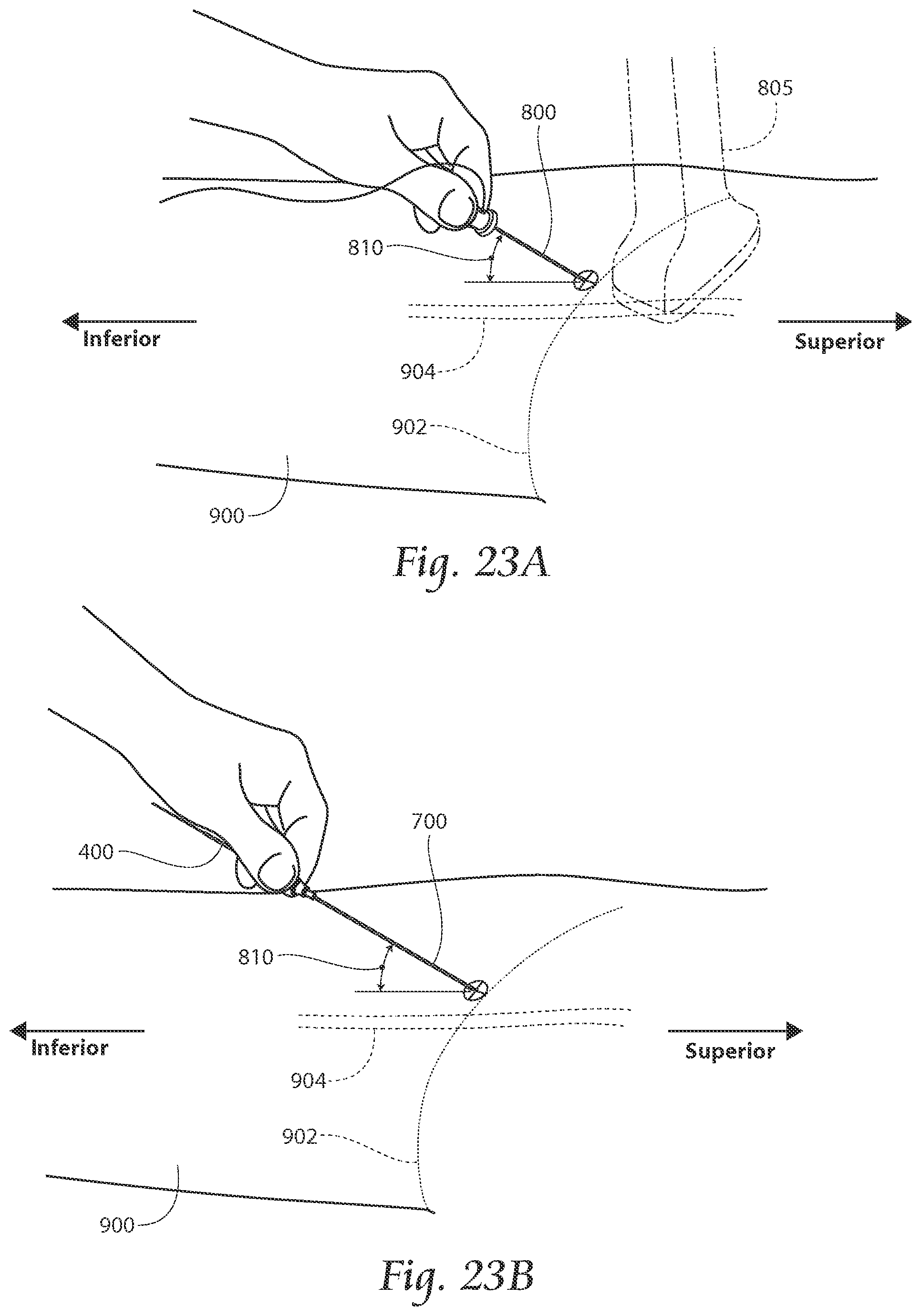 Patent US11771891 Figure 20 – Systems and methods to place one or more leads in tissue to electrically stimulate nerves of passage to treat pain