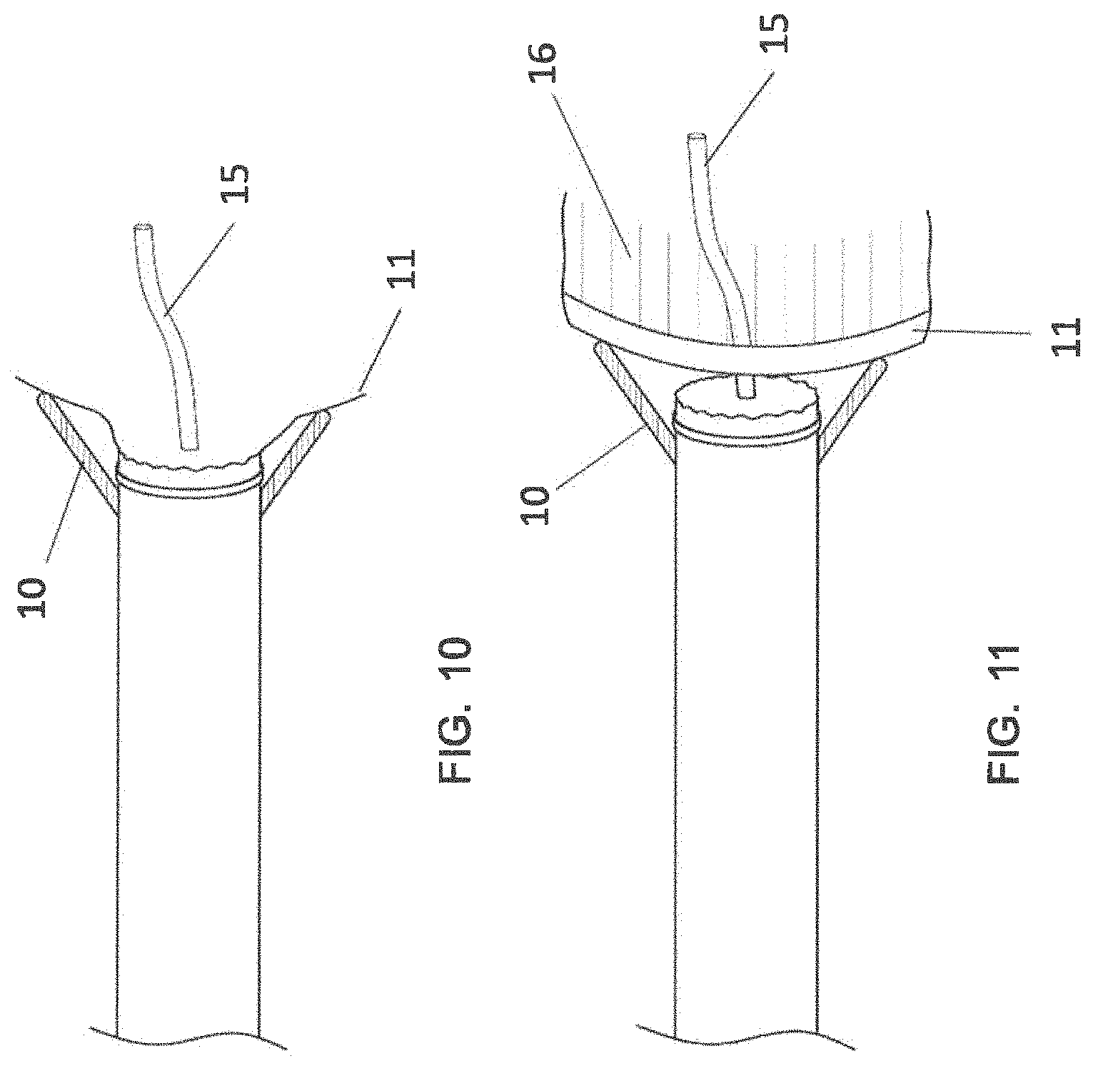 Patent US11771897 Figure 7 – System, method and catheter for pituitary and brain implantation