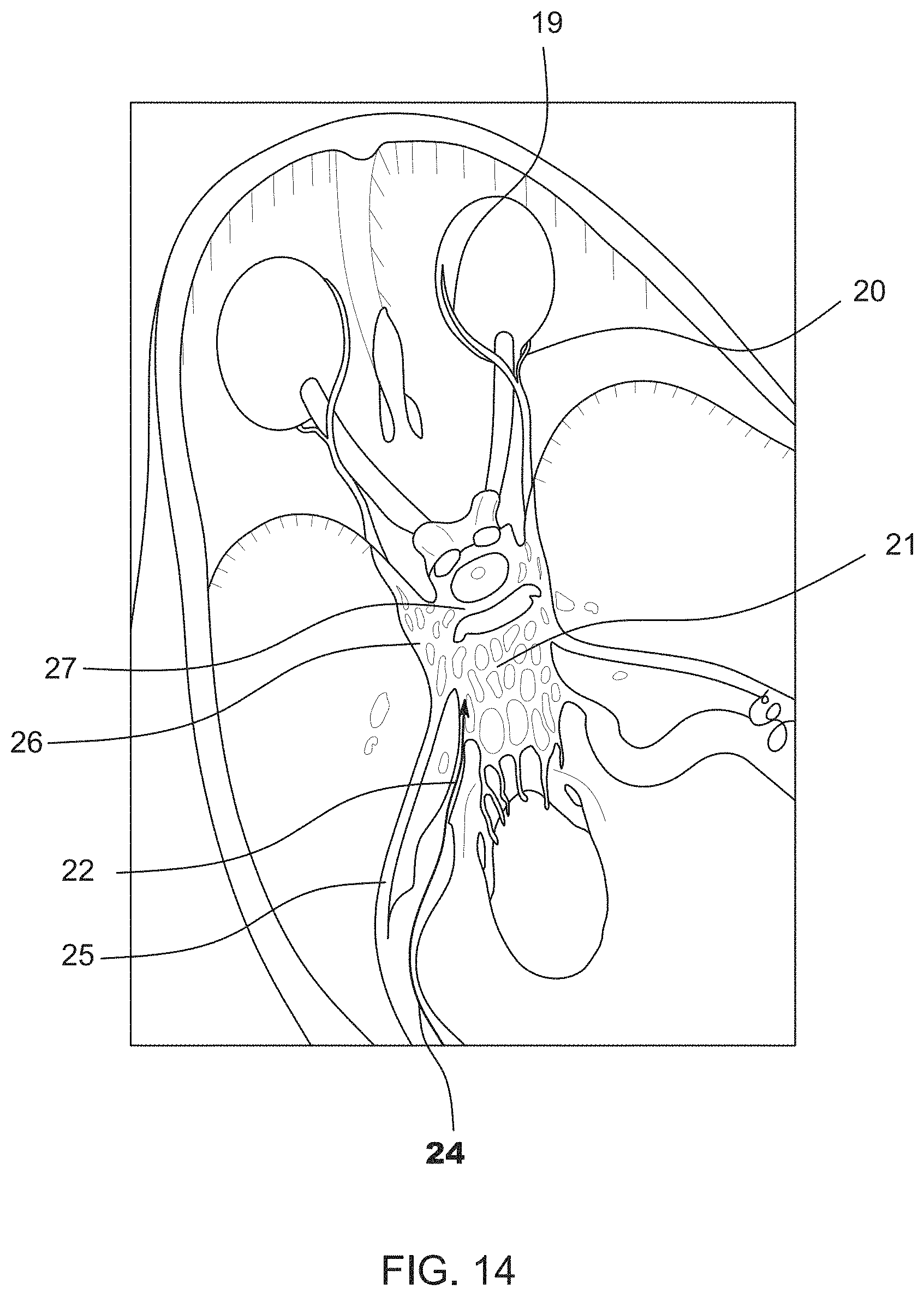 Patent US11771897 Figure 10 – System, method and catheter for pituitary and brain implantation