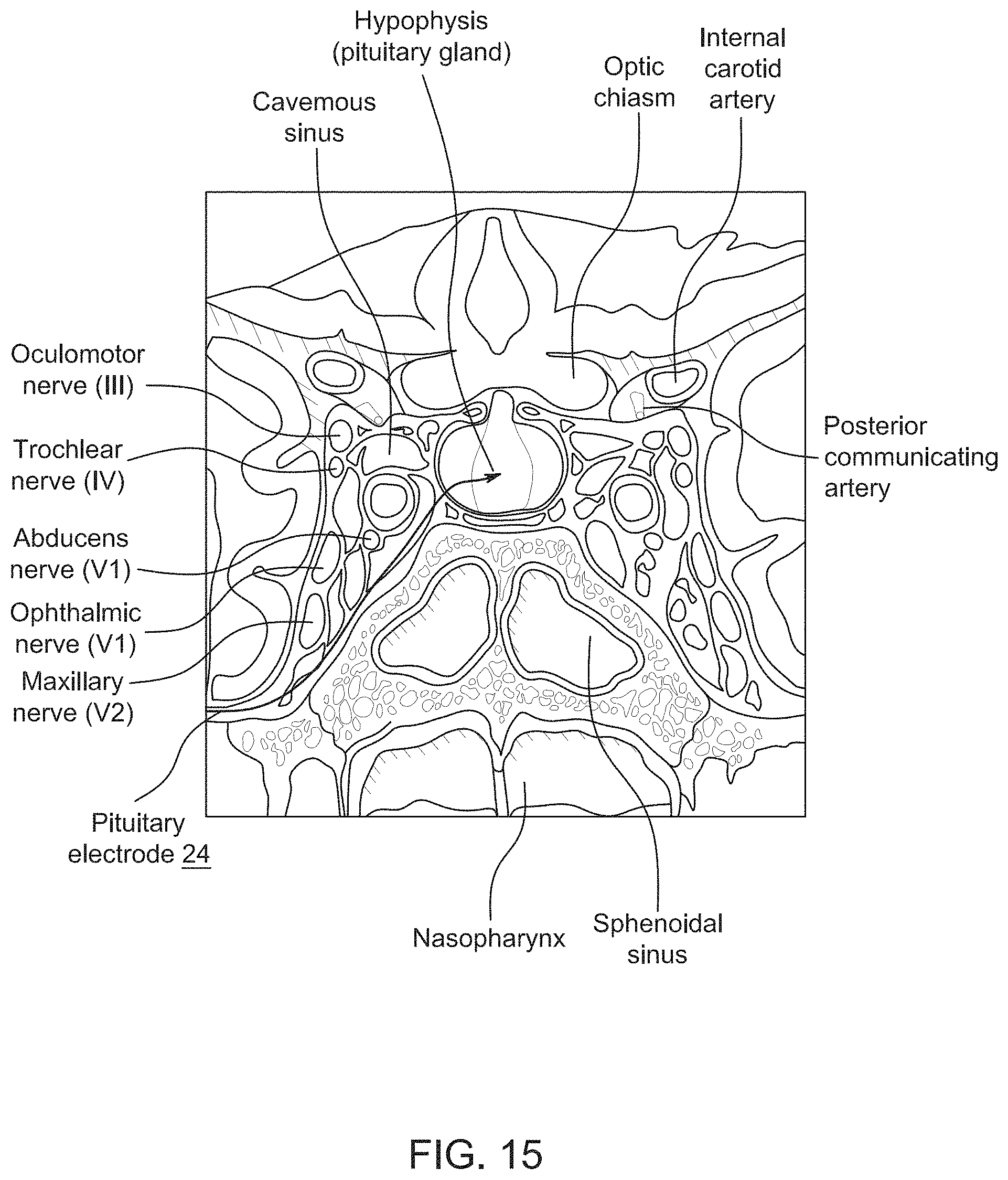 Patent US11771897 Figure 11 – System, method and catheter for pituitary and brain implantation