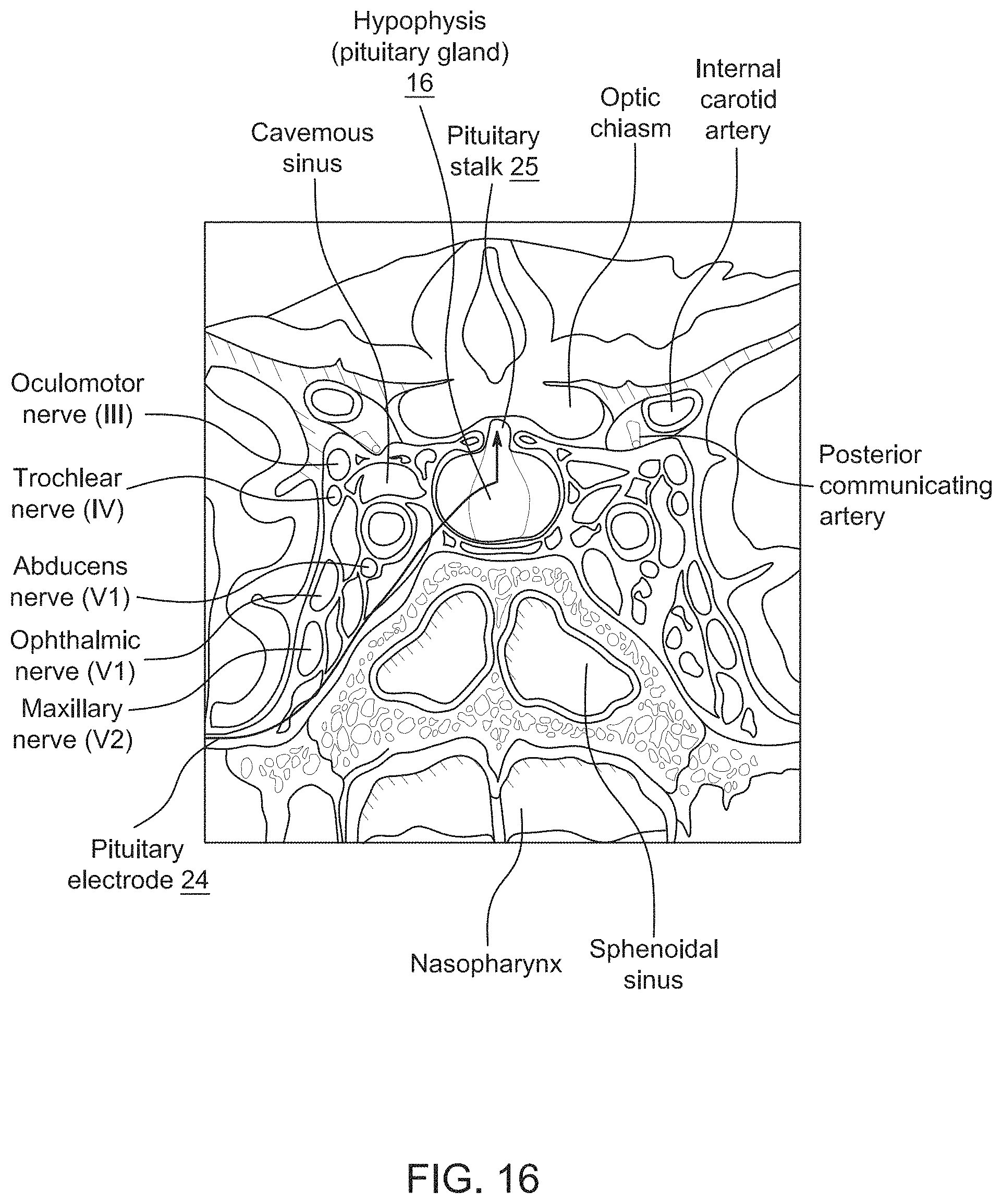 Patent US11771897 Figure 12 – System, method and catheter for pituitary and brain implantation