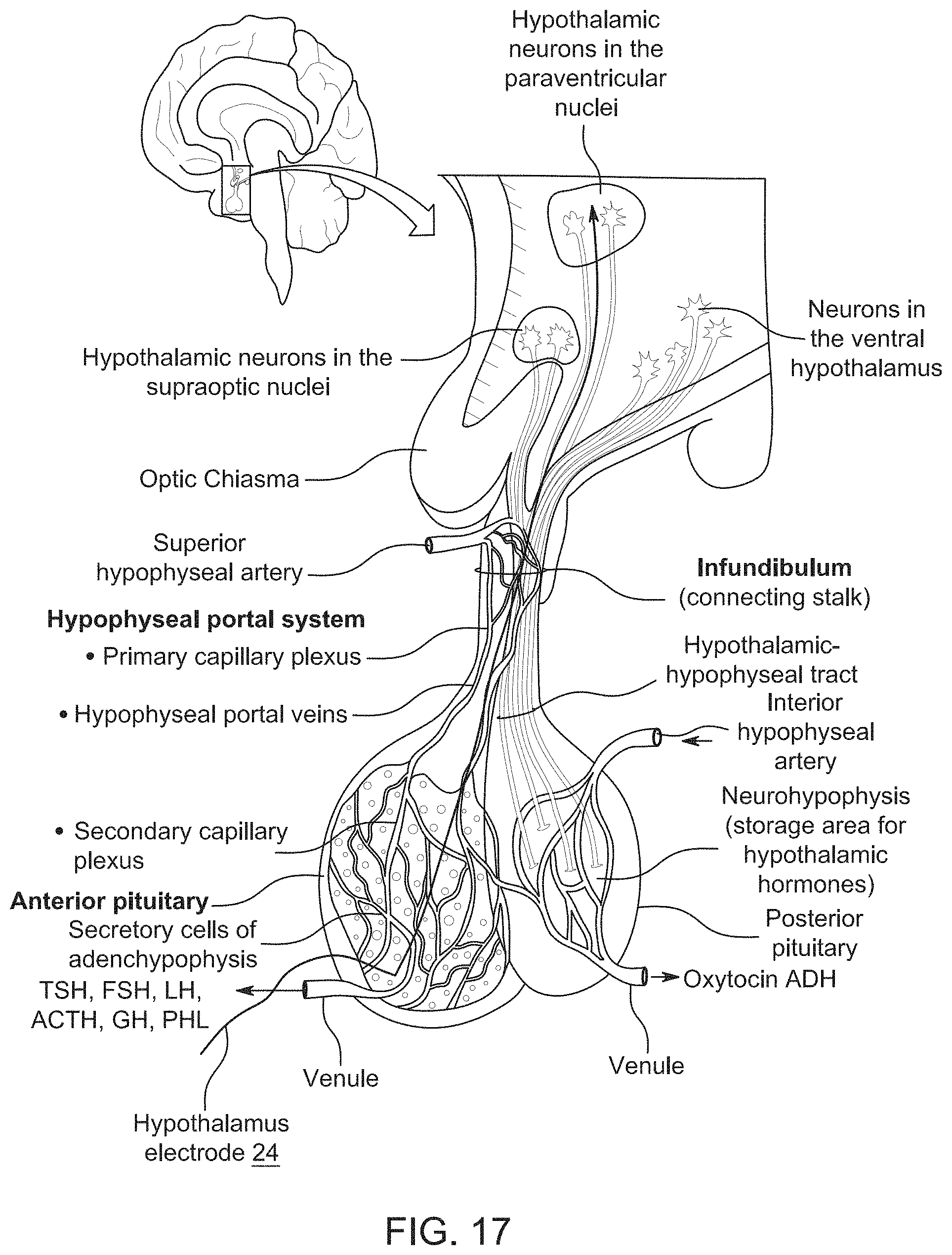 Patent US11771897 Figure 13 – System, method and catheter for pituitary and brain implantation